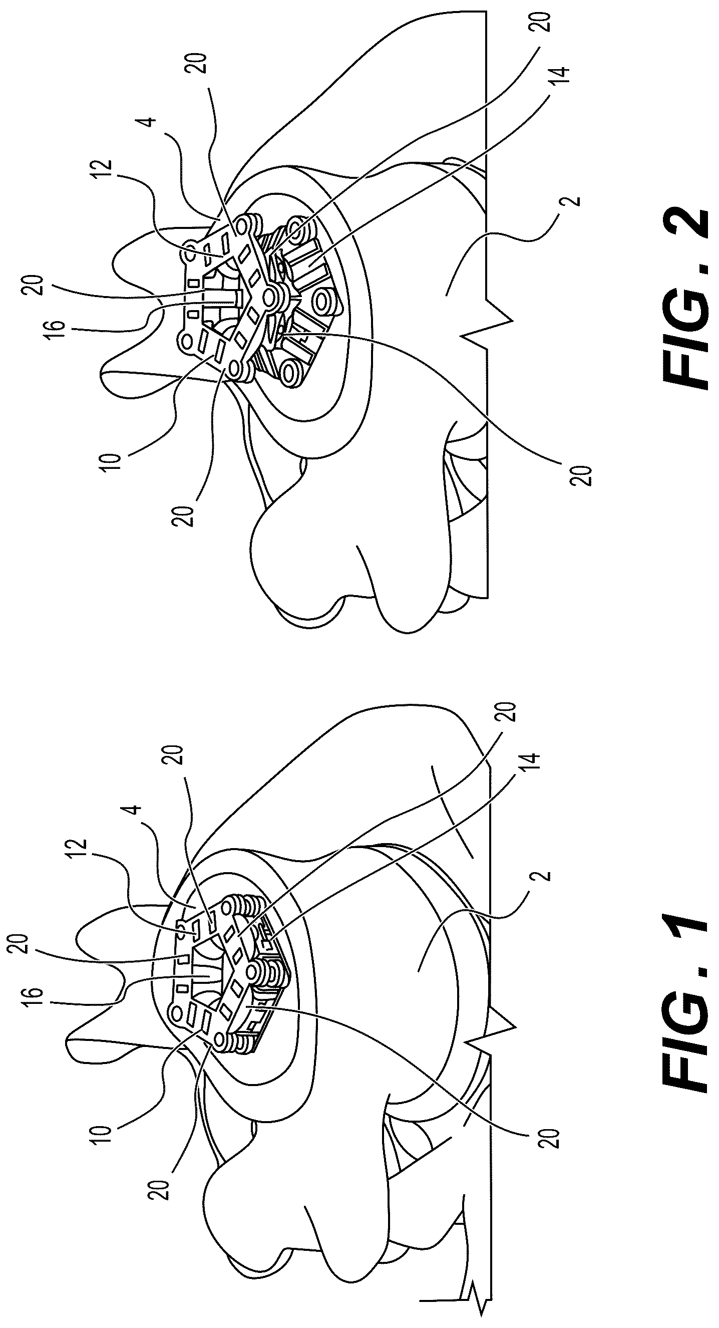 Patent US12324745 Figure 1 – Articulating expandable interbody fusions devices