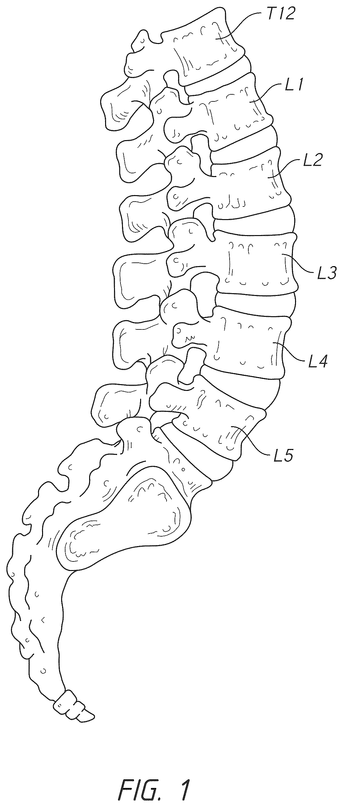 Patent US12324747 Figure 1 – Side pocket spinal fusion cage
