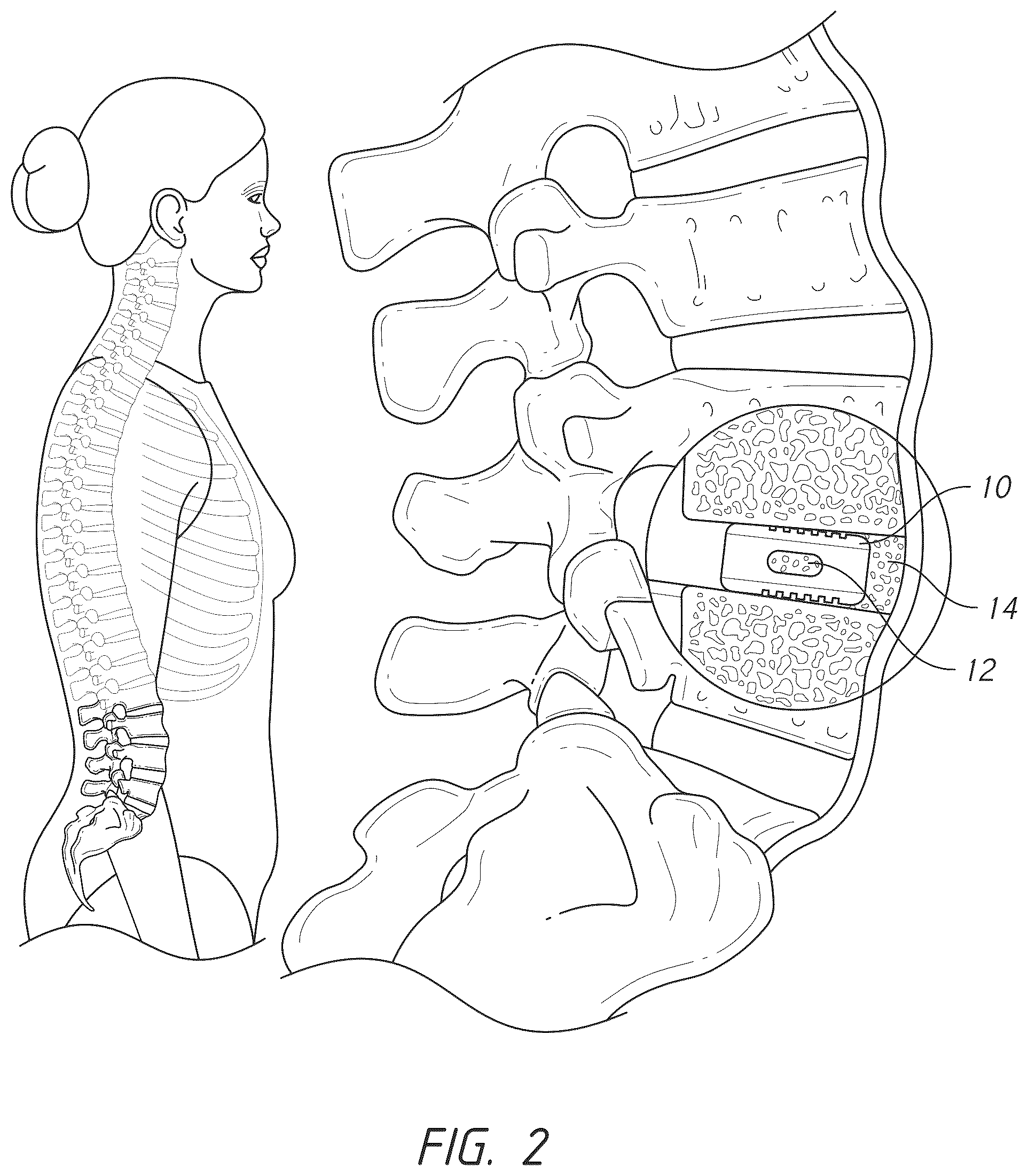 Patent US12324747 Figure 2 – Side pocket spinal fusion cage