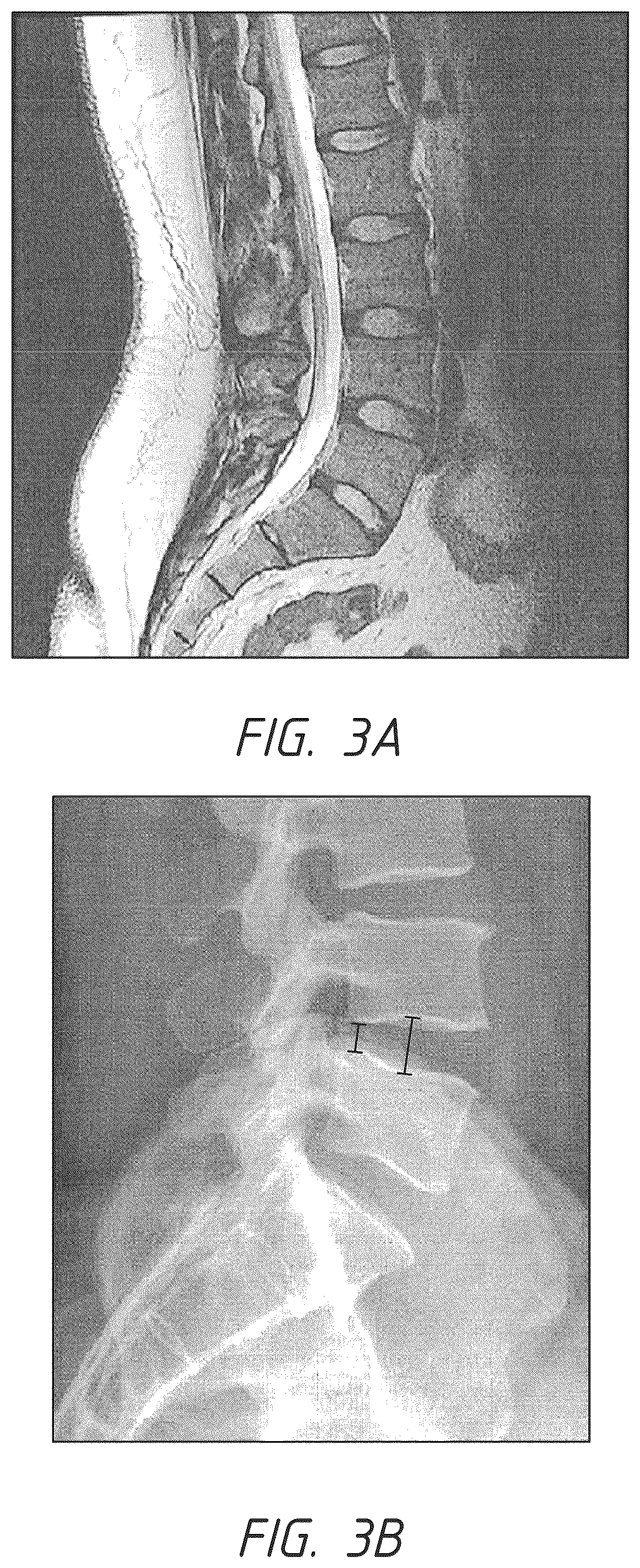 Patent US12324747 Figure 3 – Side pocket spinal fusion cage