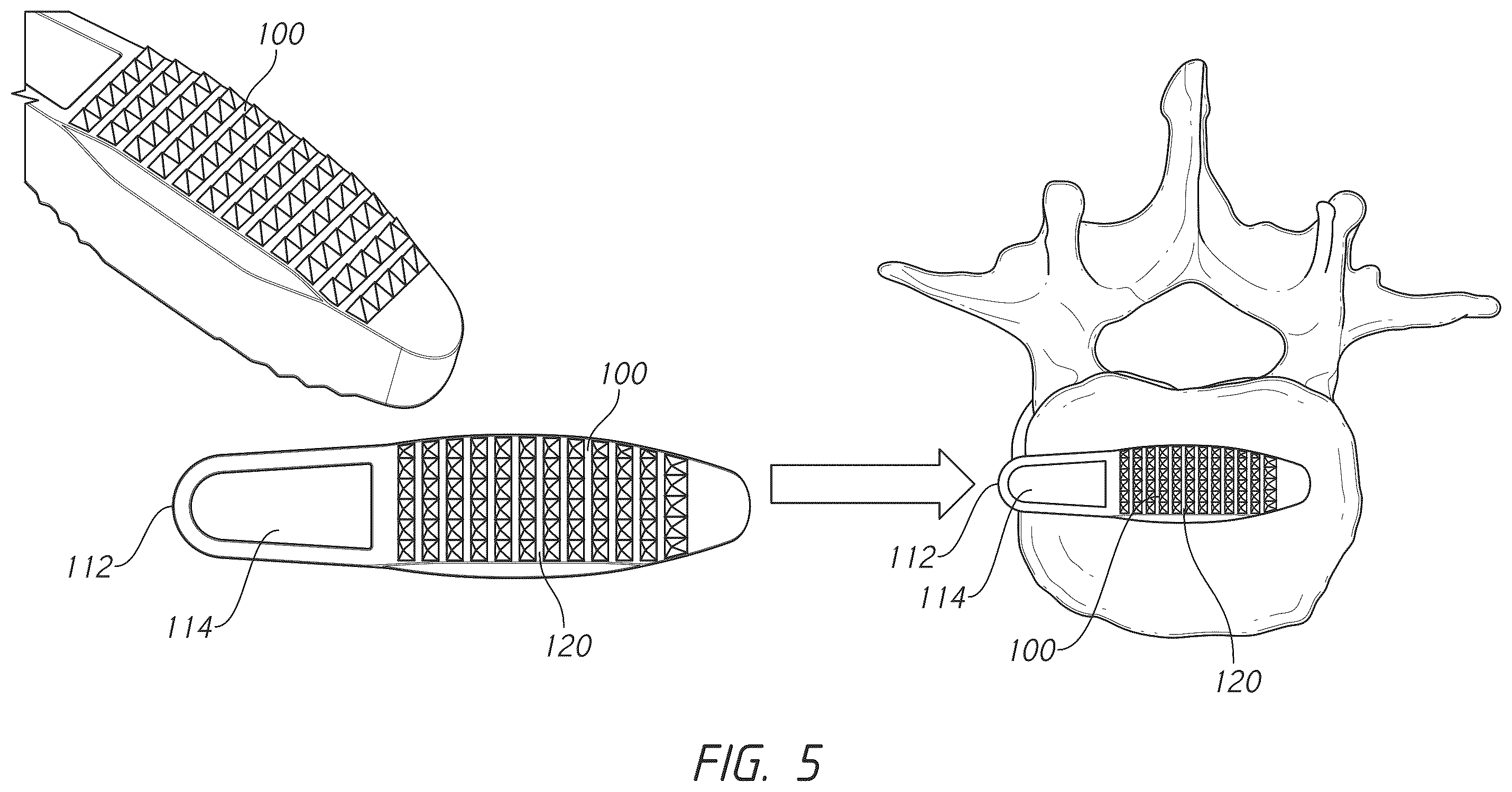 Patent US12324747 Figure 5 – Side pocket spinal fusion cage