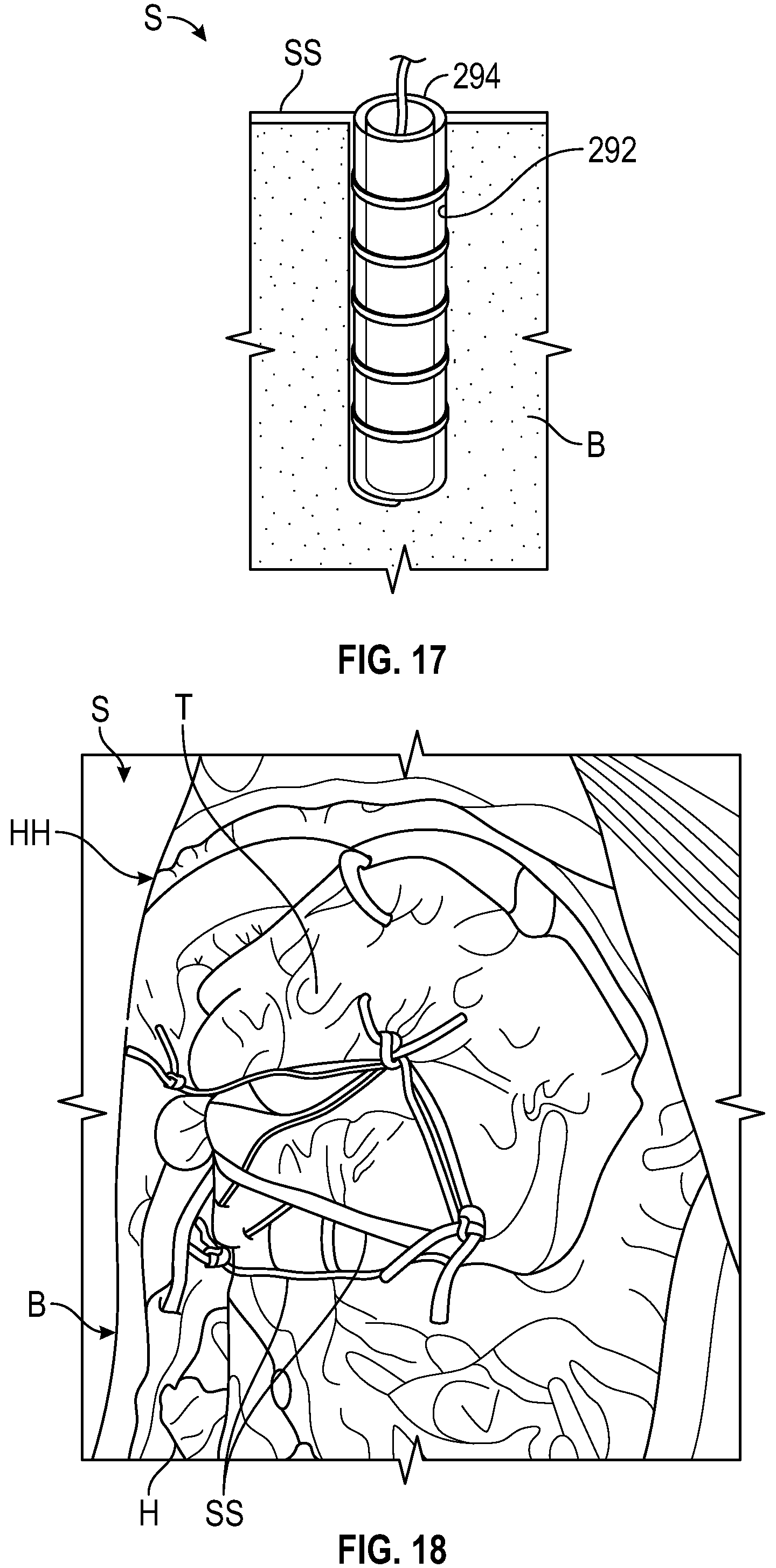 Patent US12324750 Figure 14 – Shield guide assembly