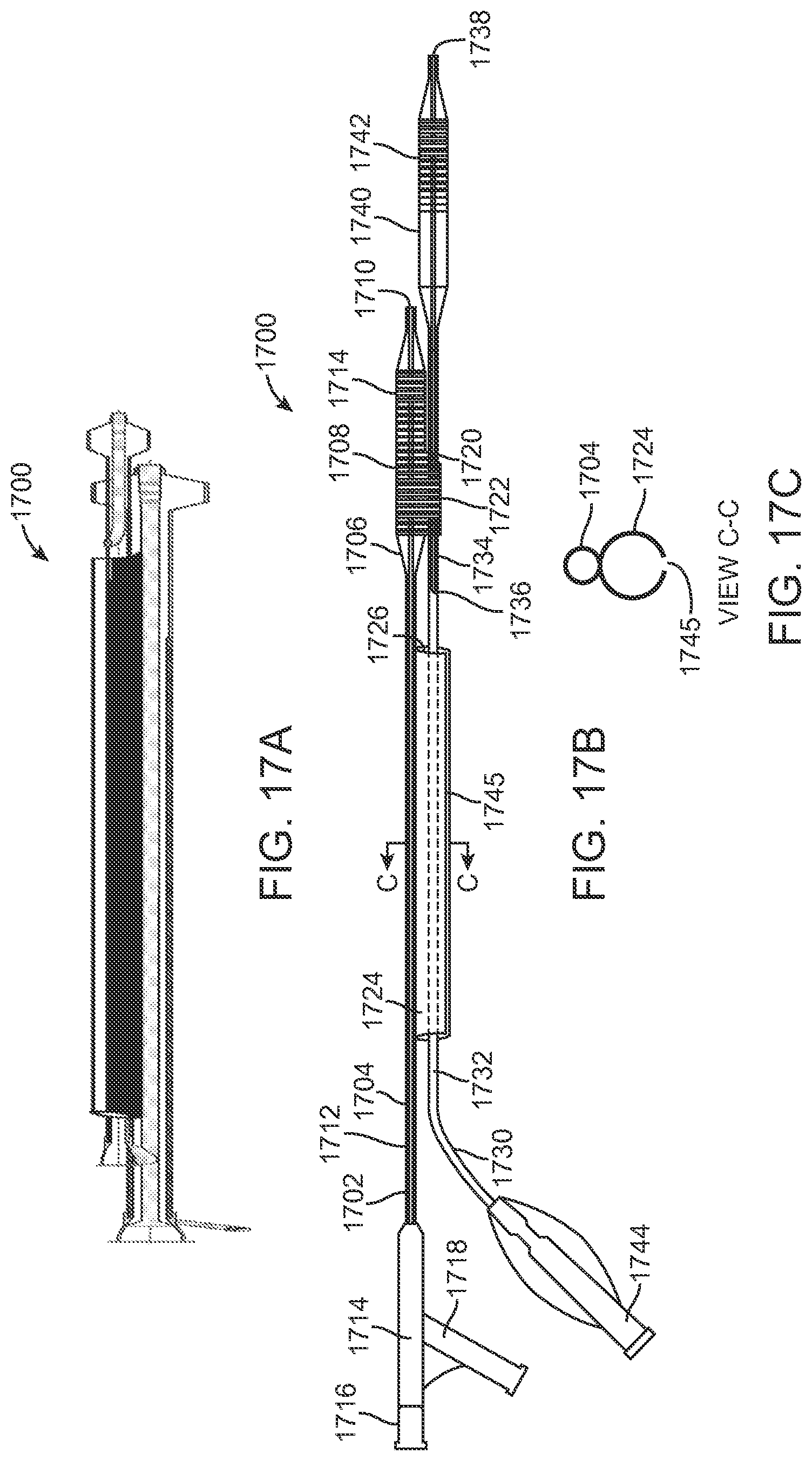 Patent US12324756 Figure 17 – System and methods for treating a bifurcation