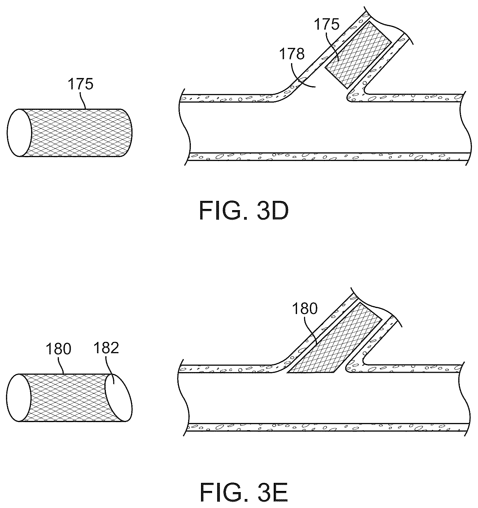 Patent US12324757 Figure 4 – Multi-stent and multi-balloon apparatus for treating bifurcations and methods of use