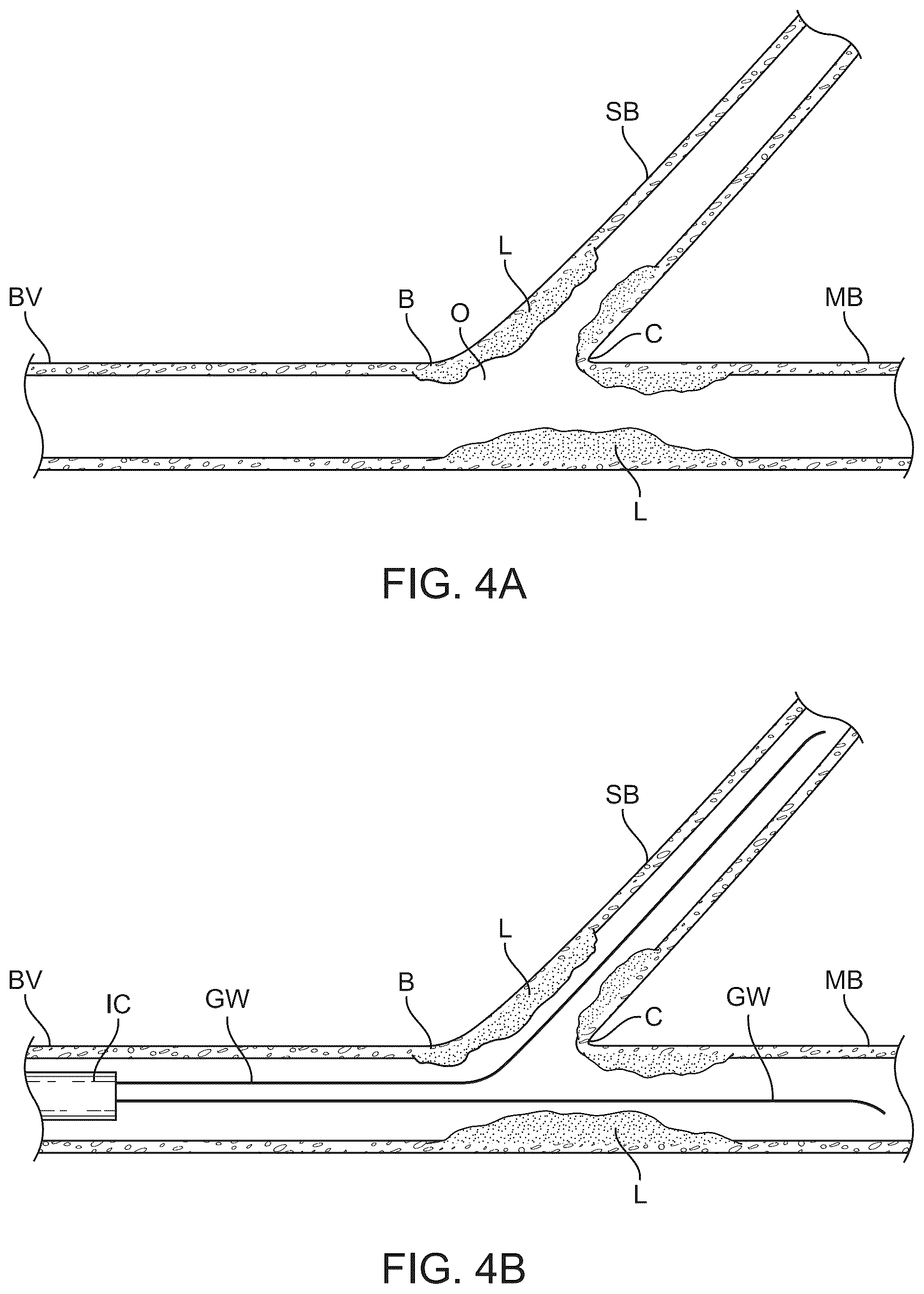 Patent US12324757 Figure 5 – Multi-stent and multi-balloon apparatus for treating bifurcations and methods of use