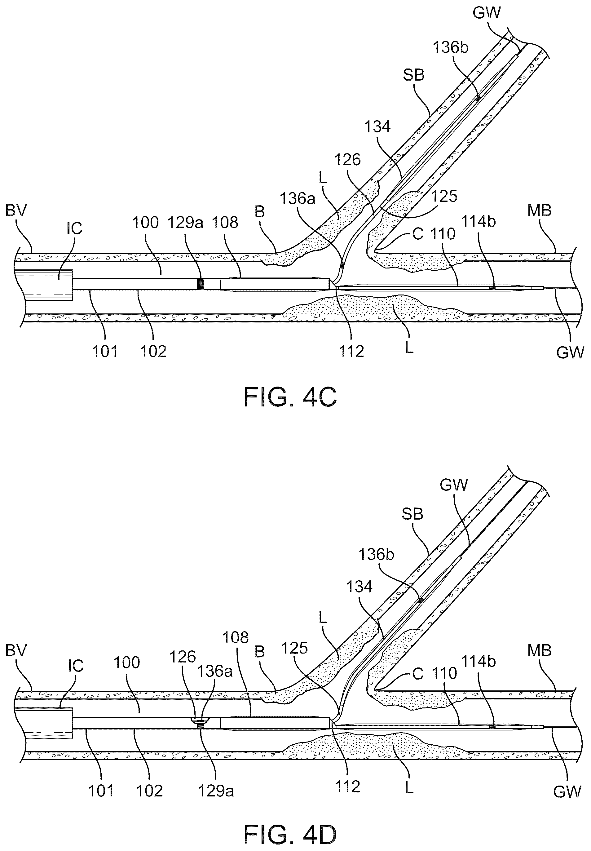 Patent US12324757 Figure 6 – Multi-stent and multi-balloon apparatus for treating bifurcations and methods of use