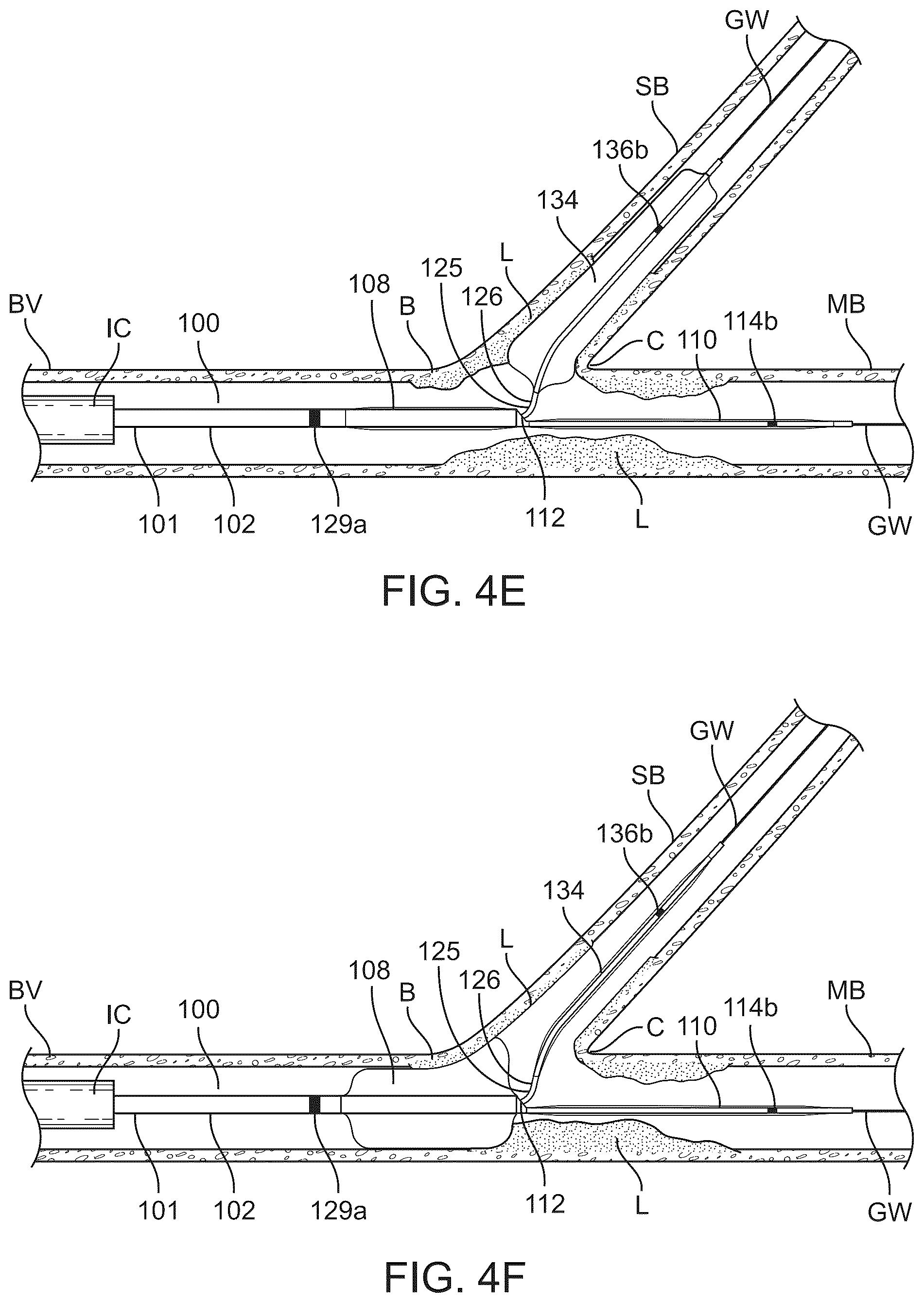 Patent US12324757 Figure 7 – Multi-stent and multi-balloon apparatus for treating bifurcations and methods of use