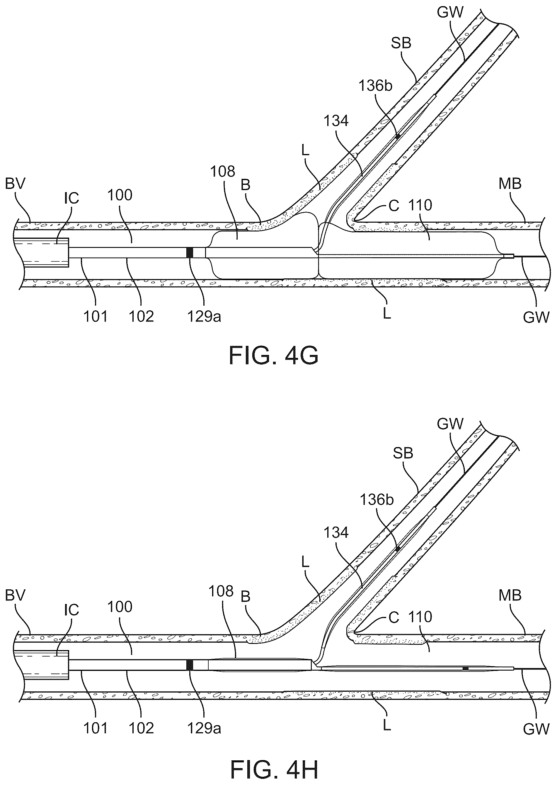 Patent US12324757 Figure 8 – Multi-stent and multi-balloon apparatus for treating bifurcations and methods of use