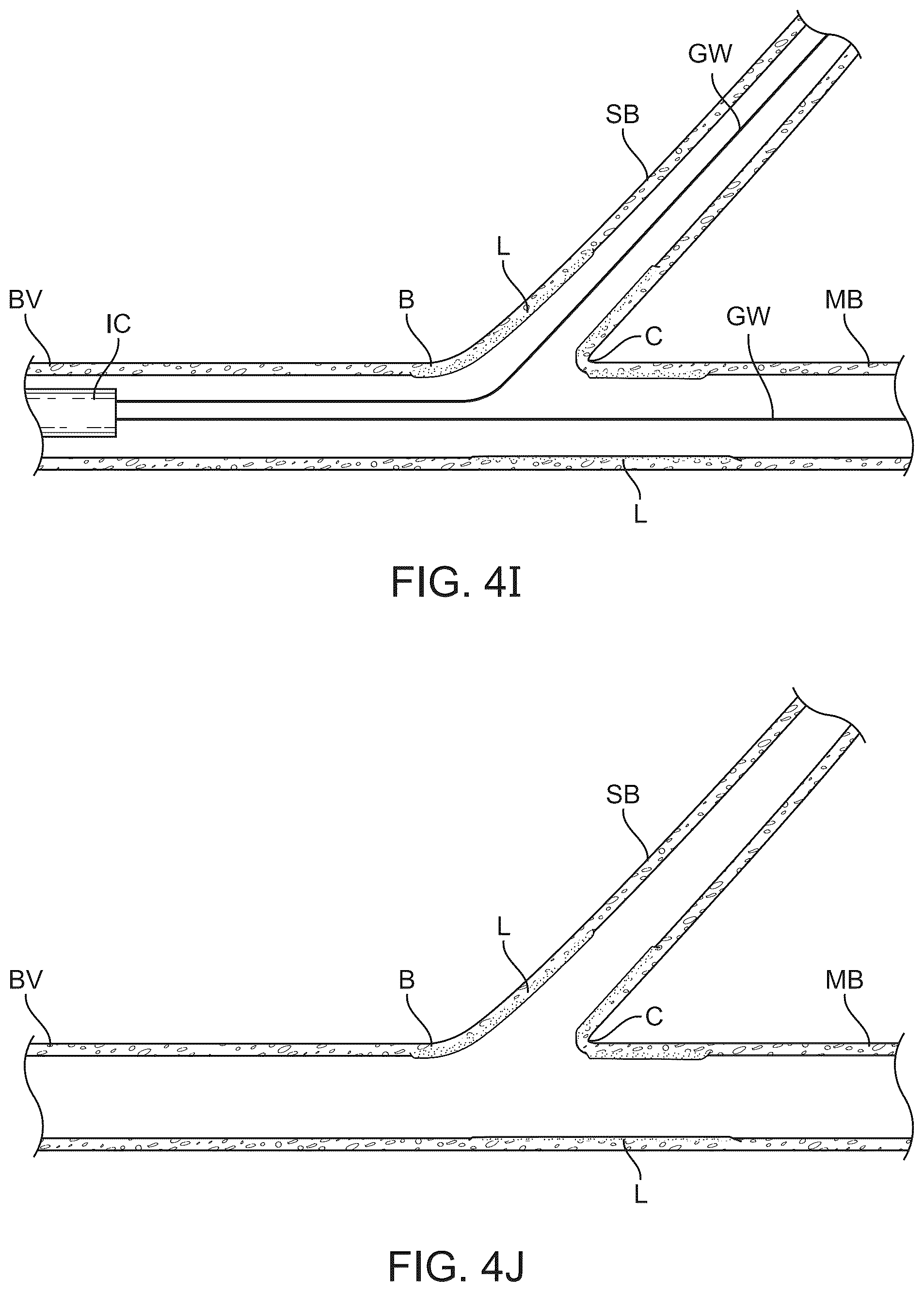 Patent US12324757 Figure 9 – Multi-stent and multi-balloon apparatus for treating bifurcations and methods of use