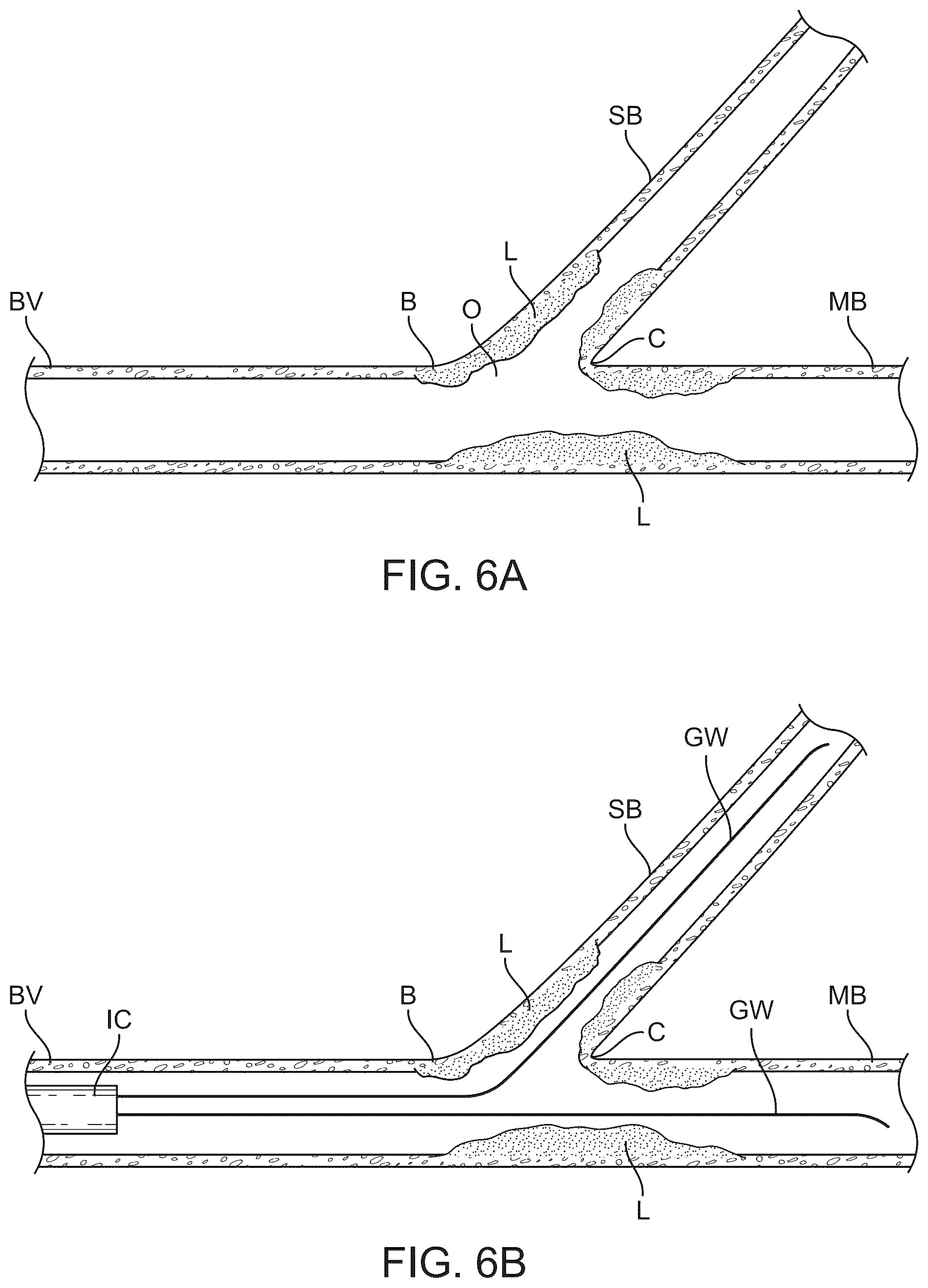 Patent US12324757 Figure 11 – Multi-stent and multi-balloon apparatus for treating bifurcations and methods of use