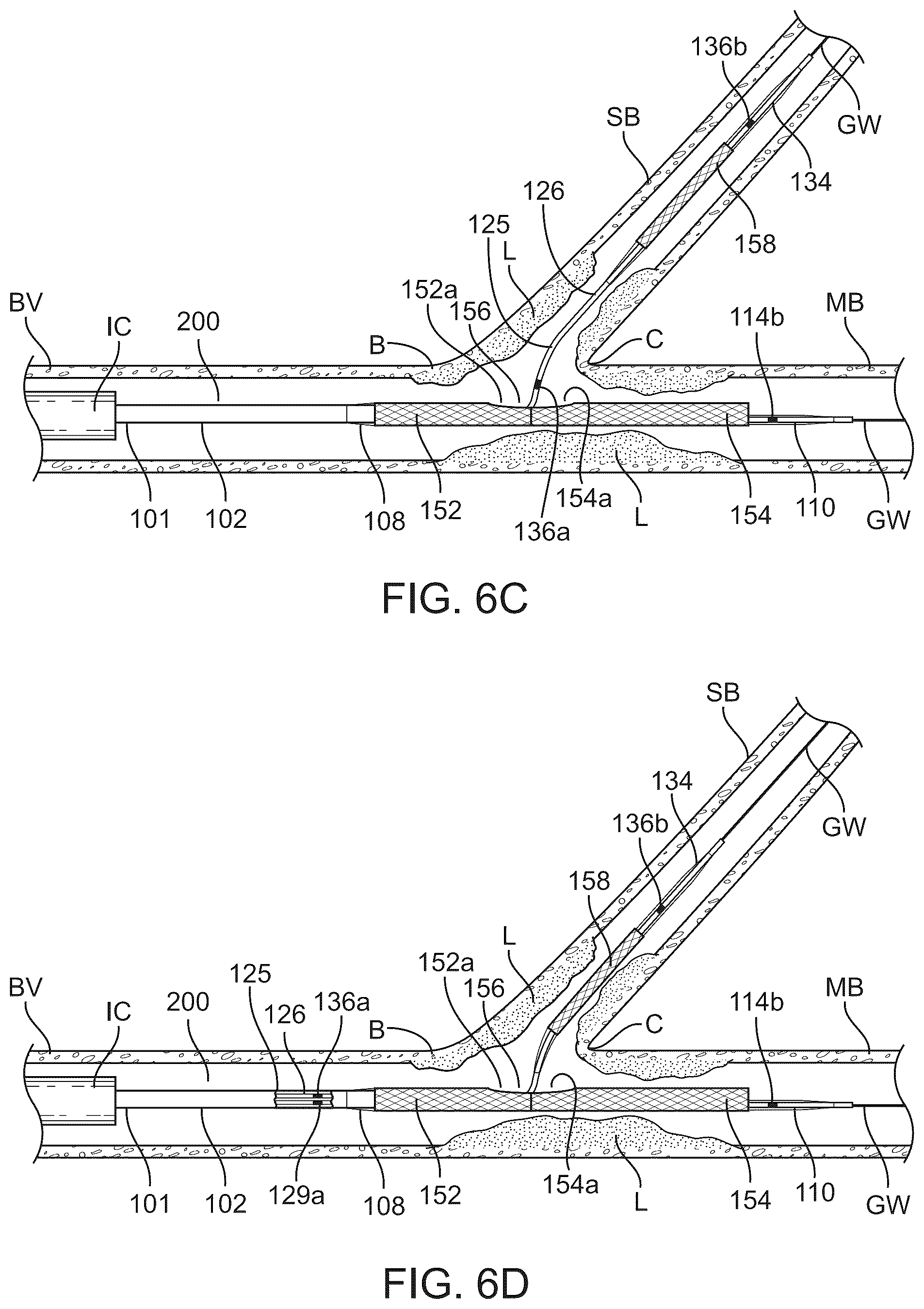 Patent US12324757 Figure 12 – Multi-stent and multi-balloon apparatus for treating bifurcations and methods of use