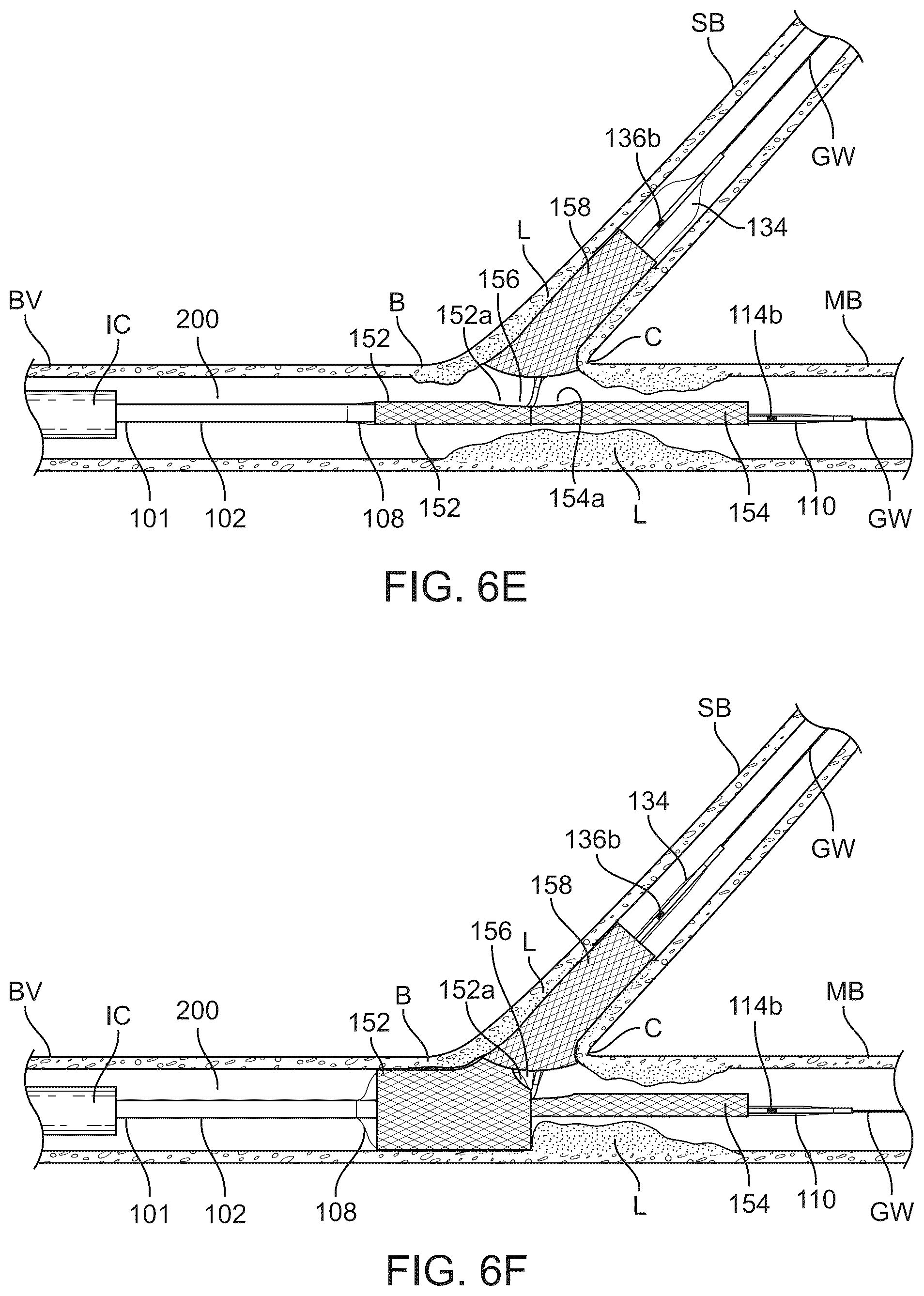 Patent US12324757 Figure 13 – Multi-stent and multi-balloon apparatus for treating bifurcations and methods of use