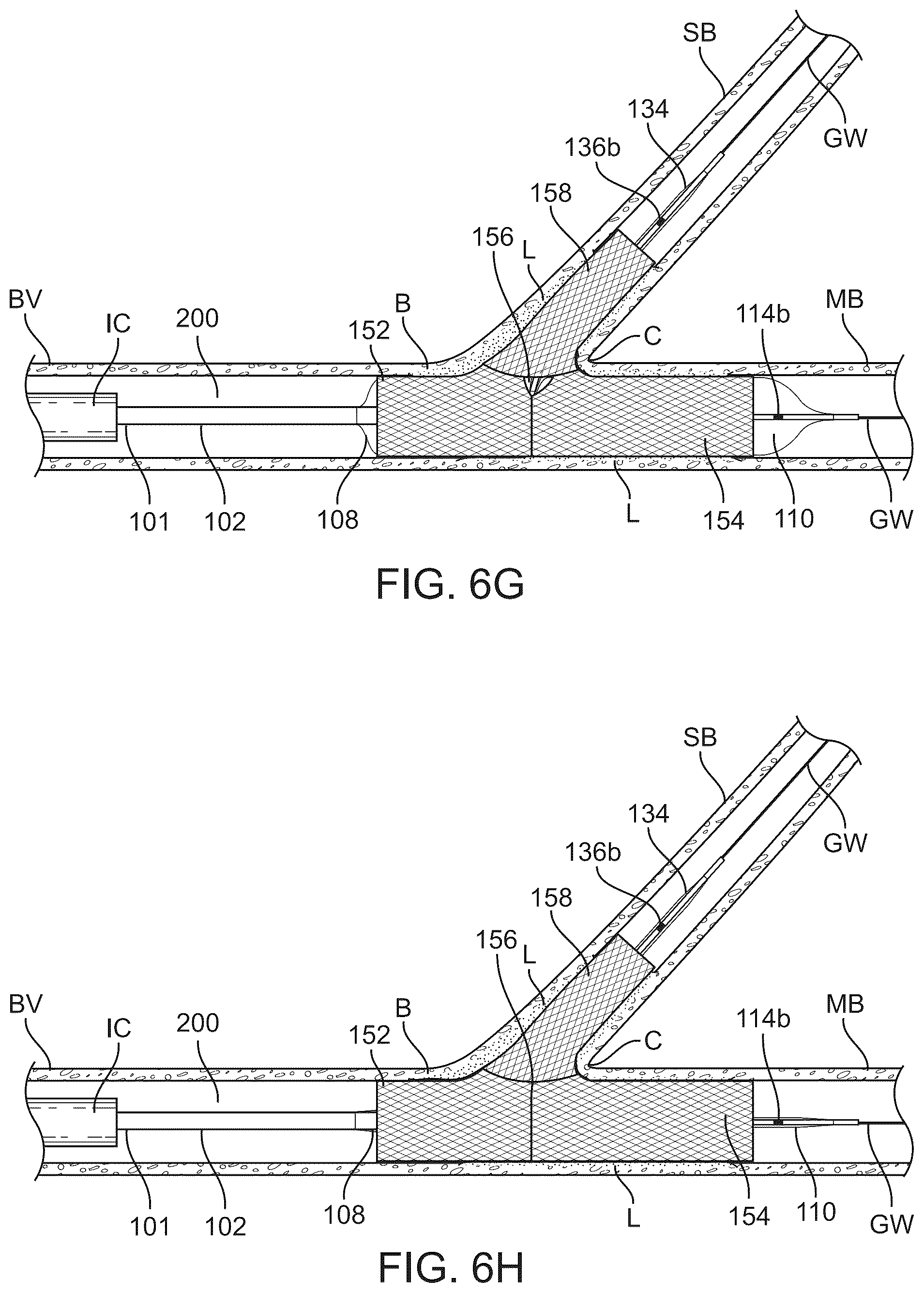 Patent US12324757 Figure 14 – Multi-stent and multi-balloon apparatus for treating bifurcations and methods of use