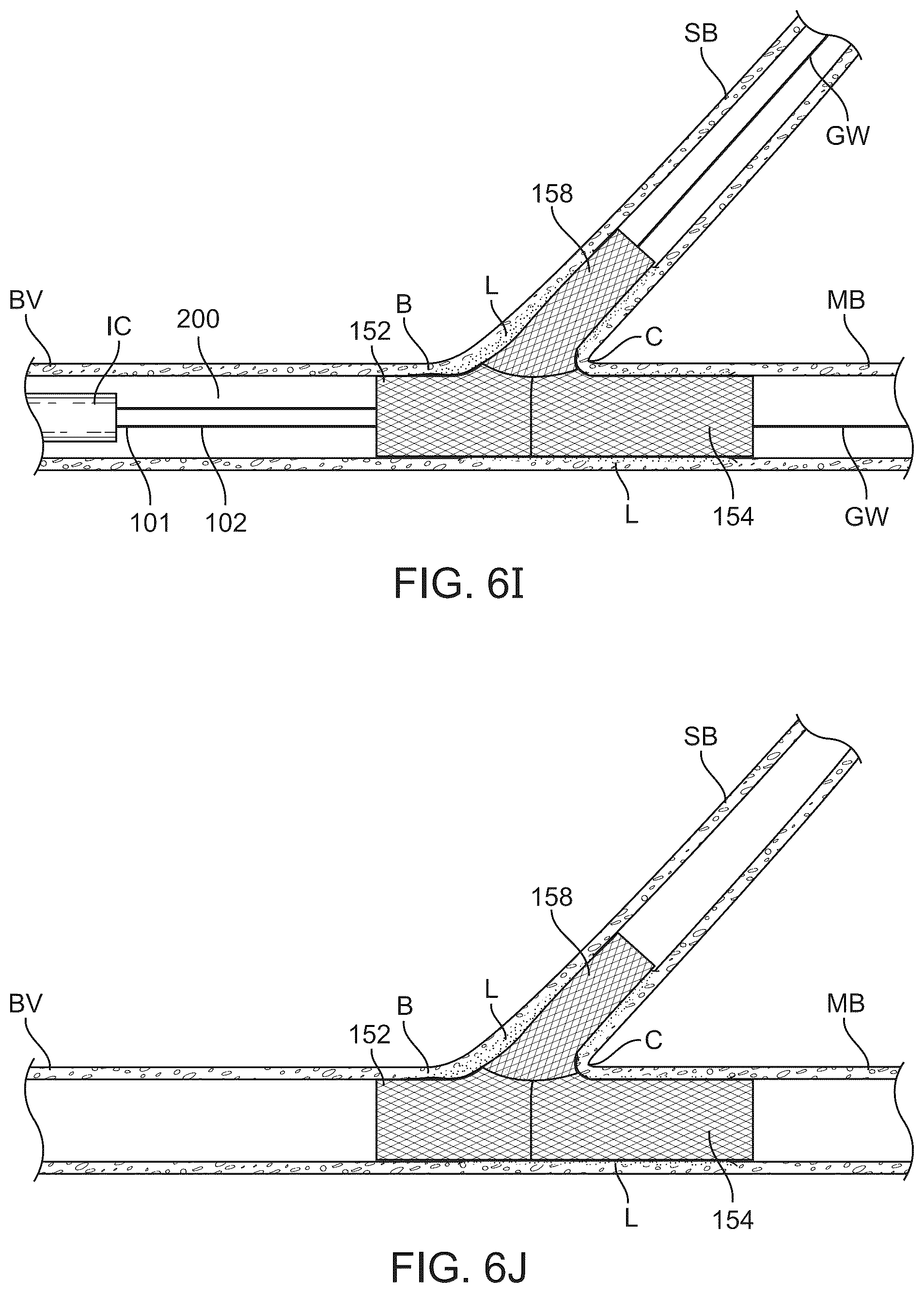 Patent US12324757 Figure 15 – Multi-stent and multi-balloon apparatus for treating bifurcations and methods of use