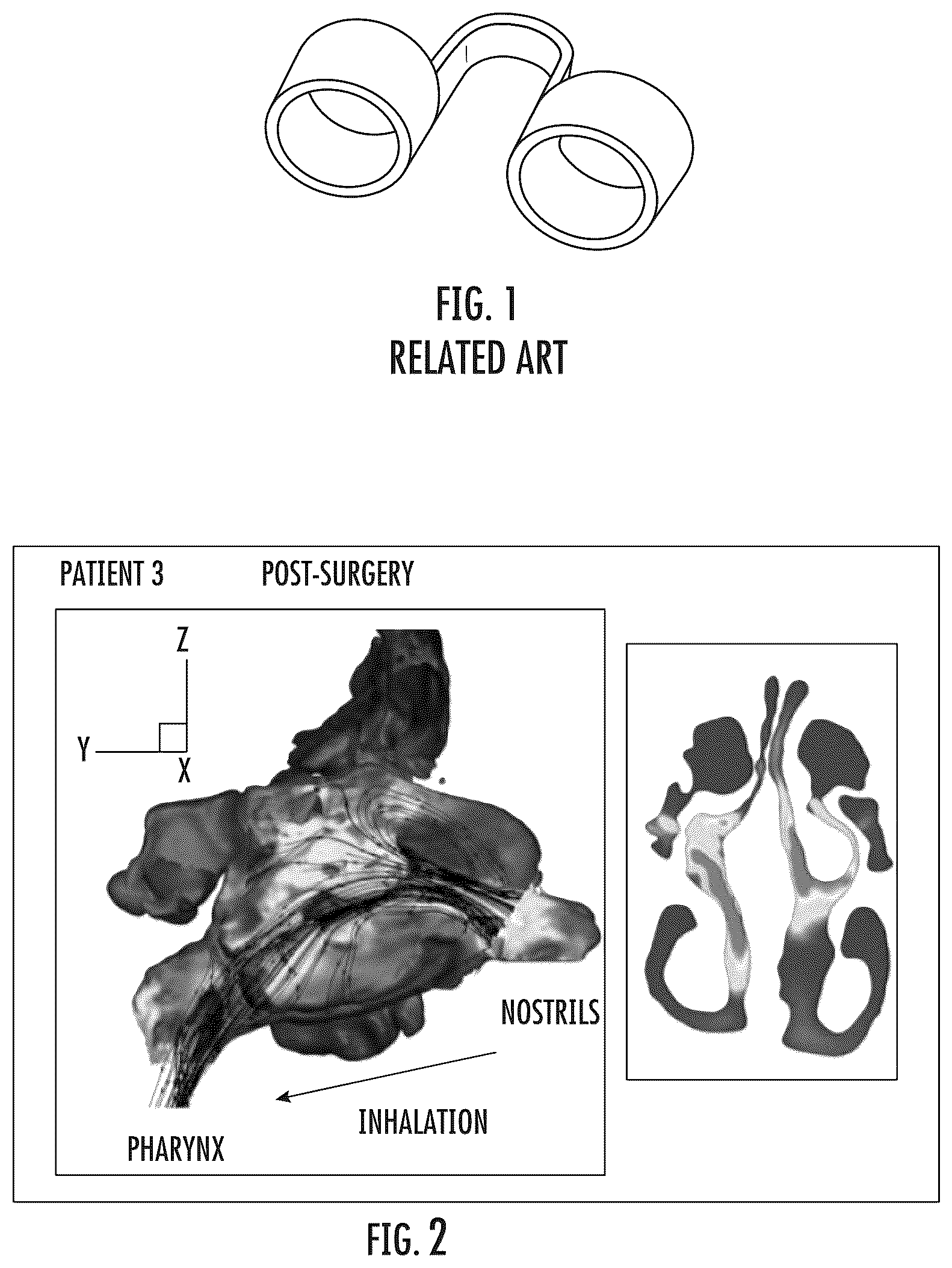 Patent US12324764 — Vented nasal plug — Figure 1