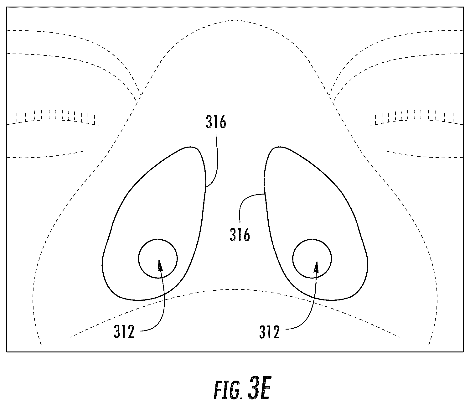 Patent US12324764 Figure 3 – Vented nasal plug