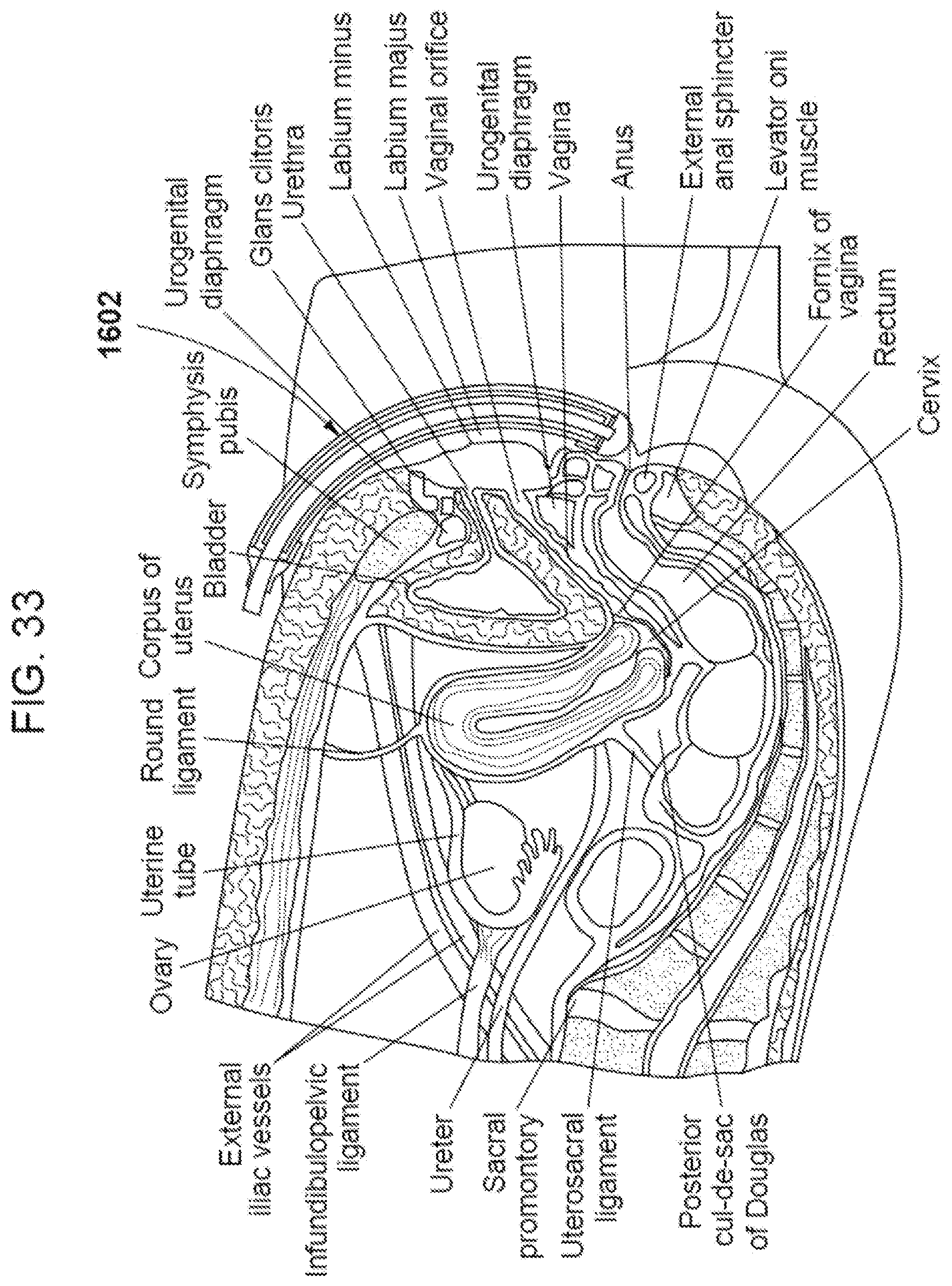 Patent US12324765 Figure 17 – Apparatus and methods for receiving discharged urine