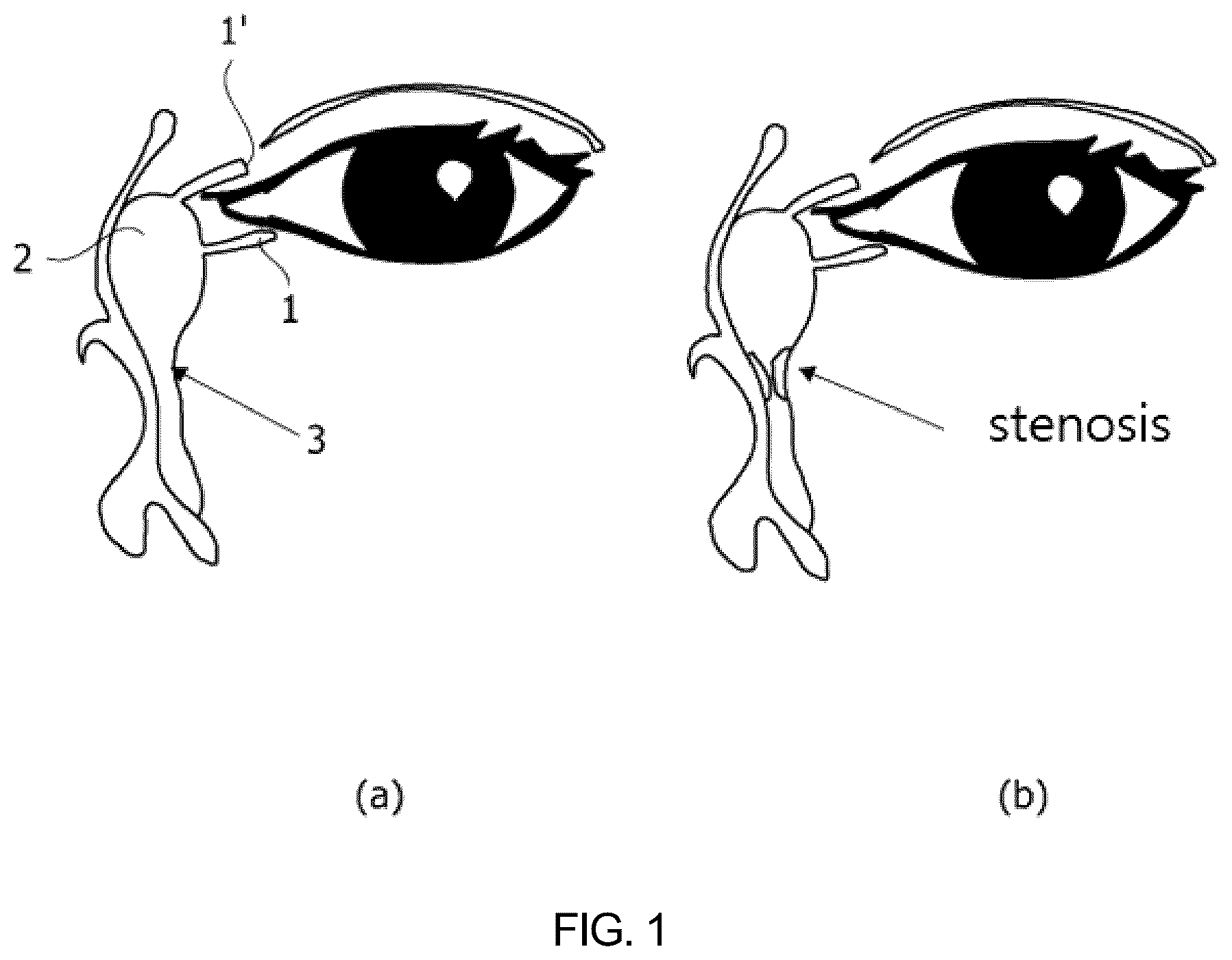 Patent US12324870 — Nasolacrimal duct insertion member comprising shape memory polymer — Figure 1