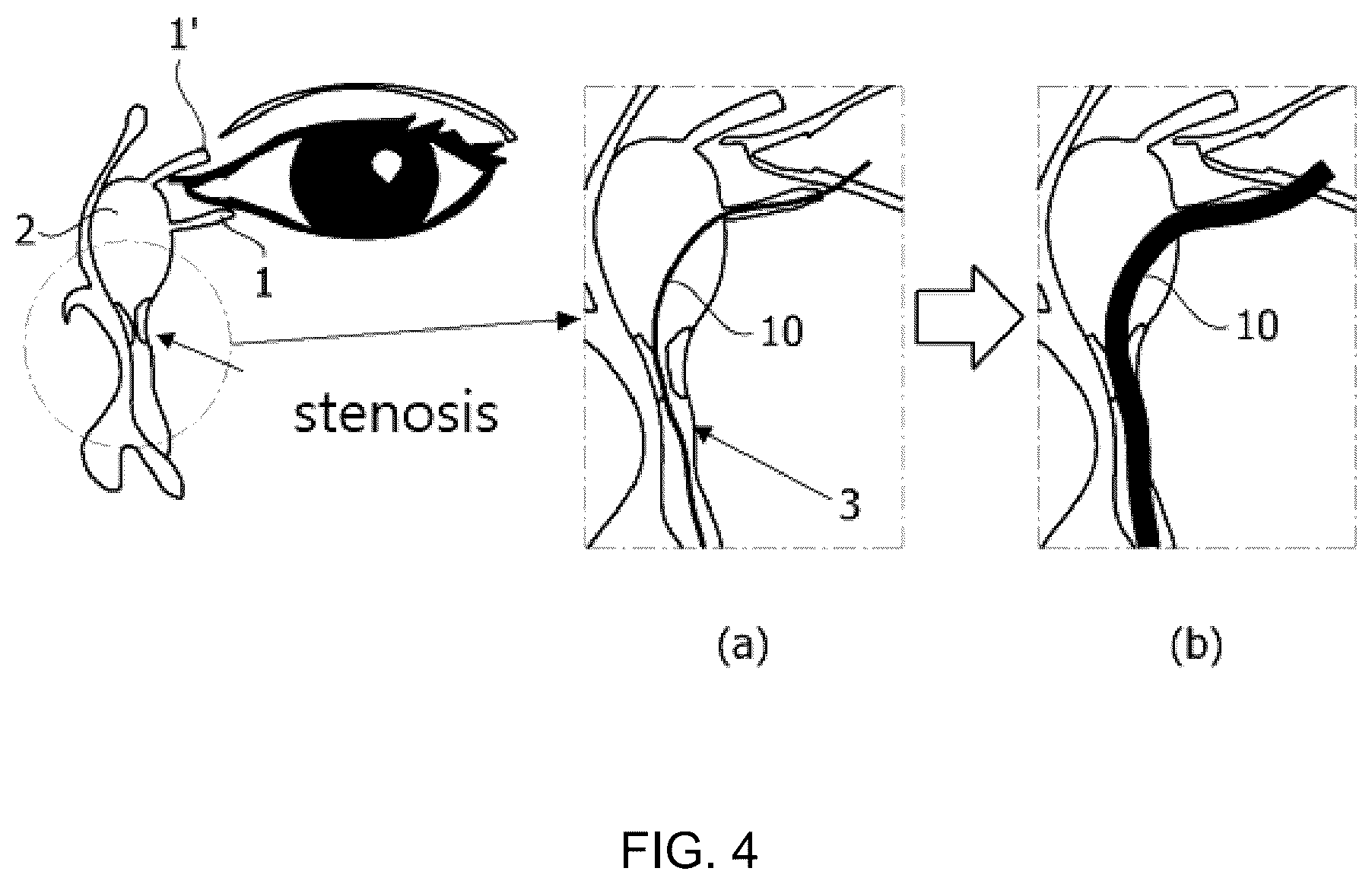 Patent US12324870 Figure 4 – Nasolacrimal duct insertion member comprising shape memory polymer