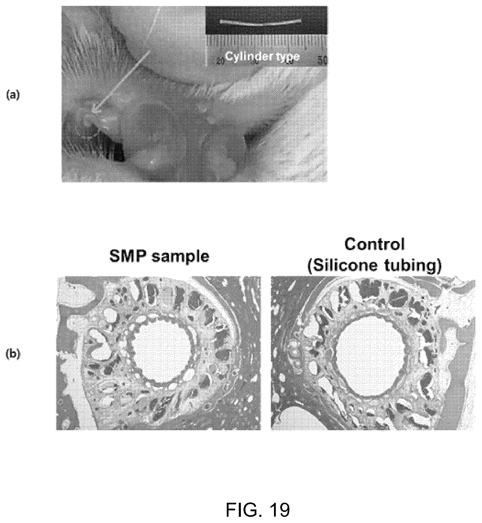 Patent US12324870 Figure 19 – Nasolacrimal duct insertion member comprising shape memory polymer