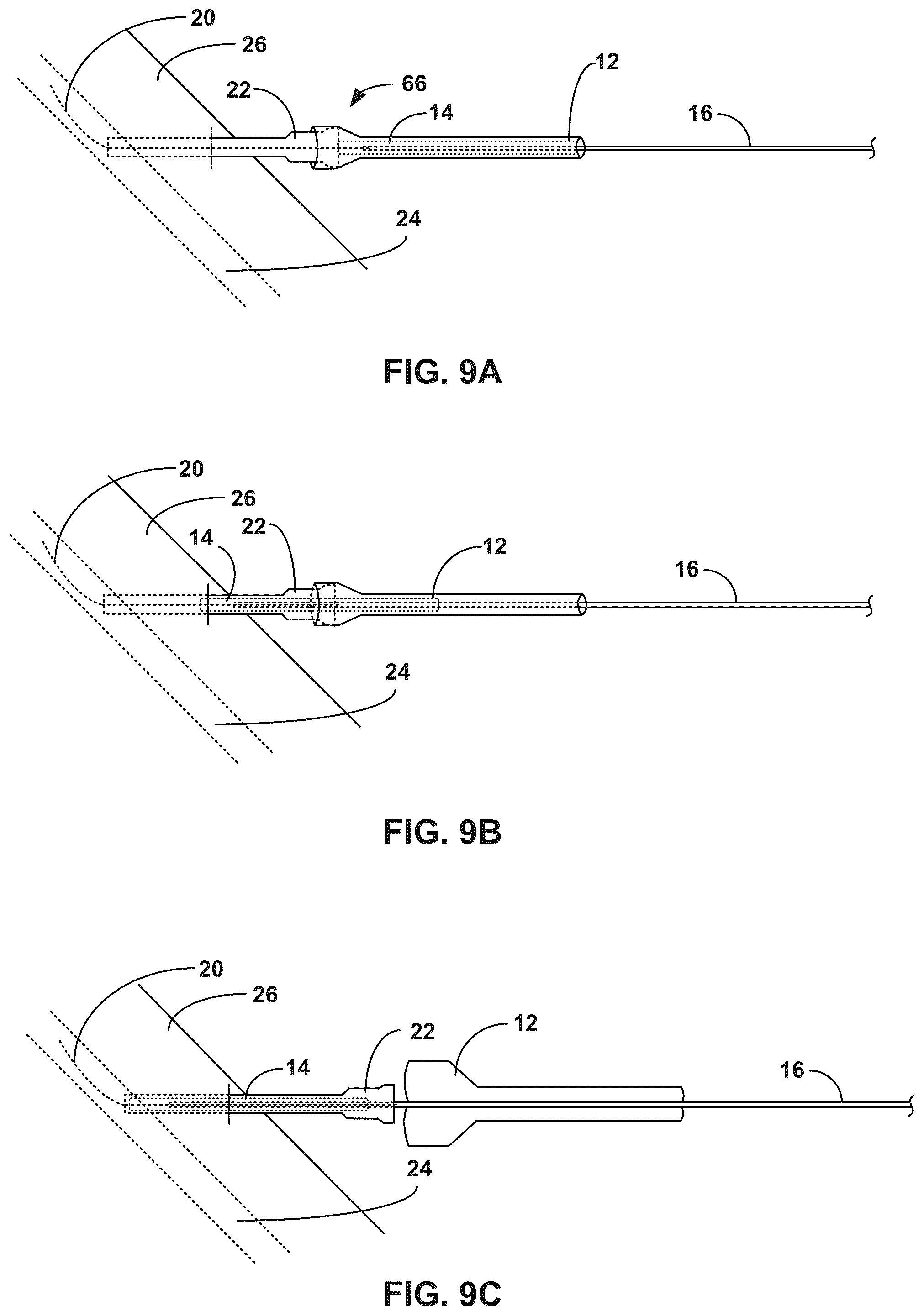 Patent US12324883 Figure 9 – Expandable balloon sheaths