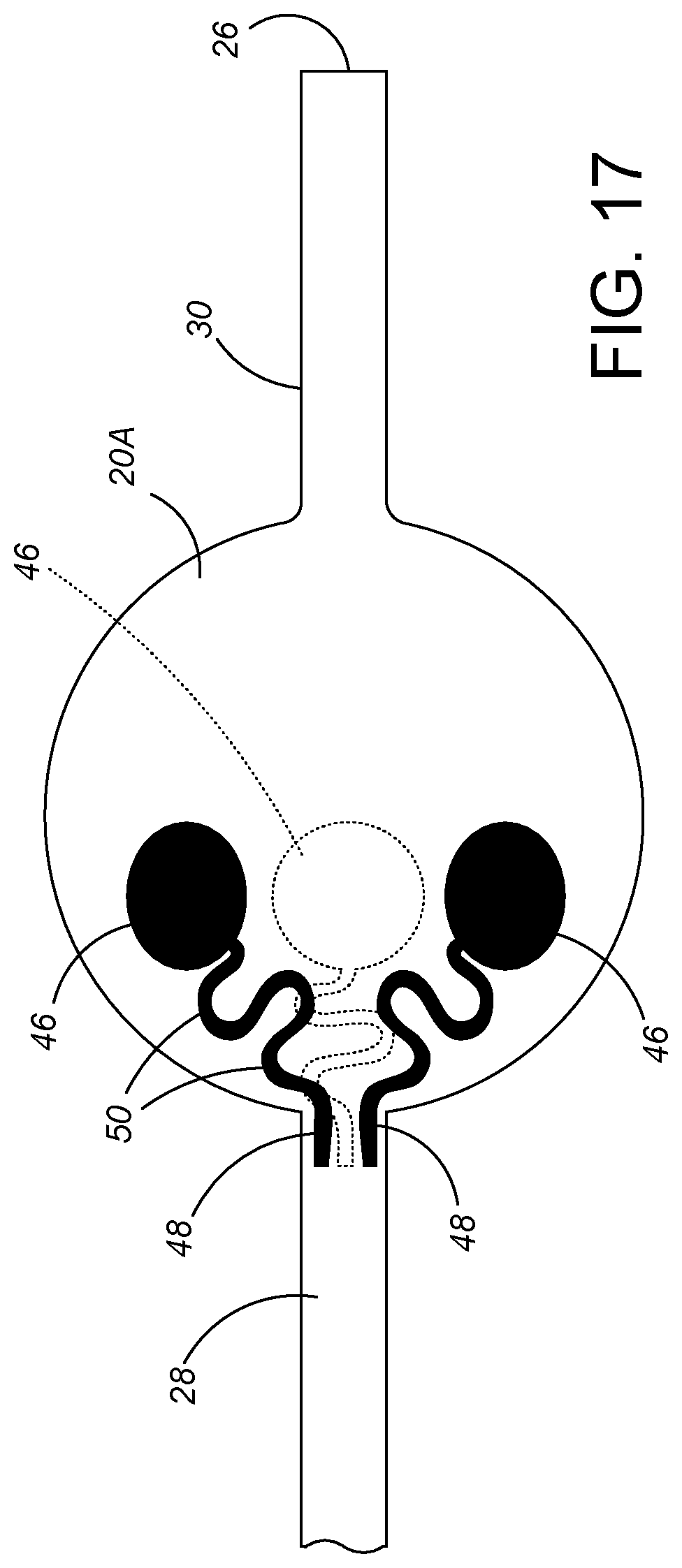 Patent US12324887 Figure 8 – Microminiature patterned metal on medical grade balloons