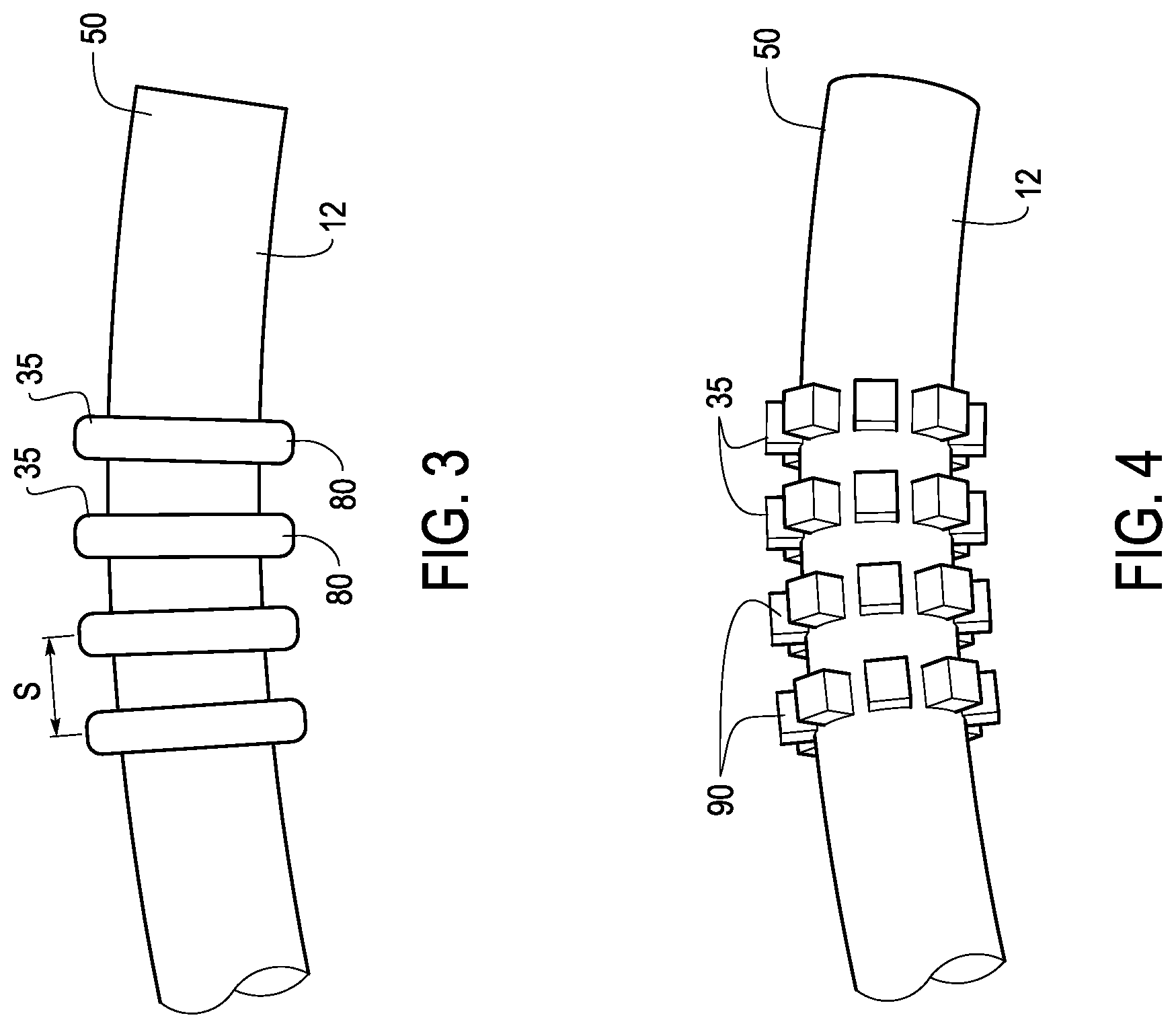 Patent US12324888 Figure 4 – Ureteral stent with anti-migration features