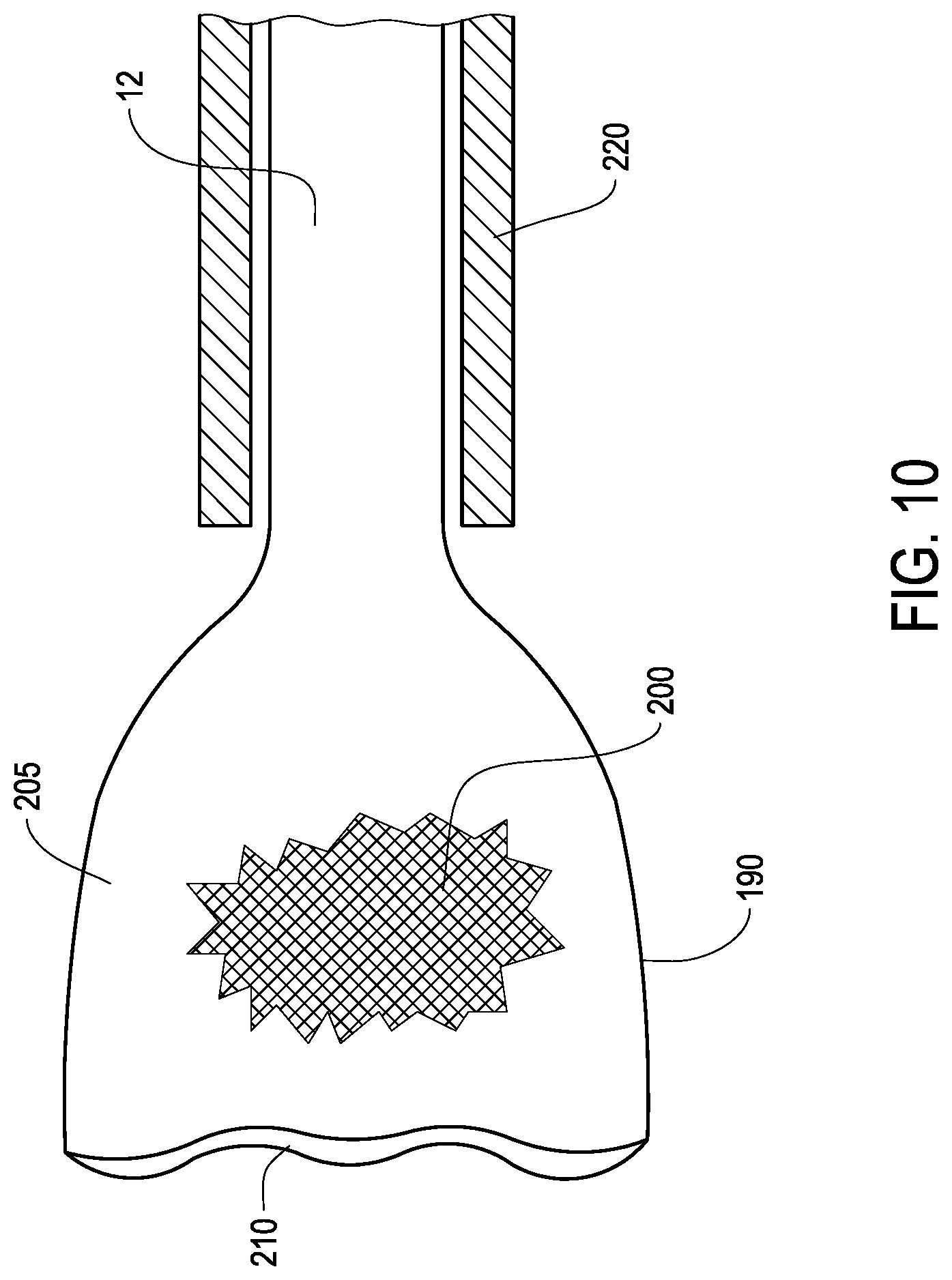 Patent US12324888 Figure 10 – Ureteral stent with anti-migration features