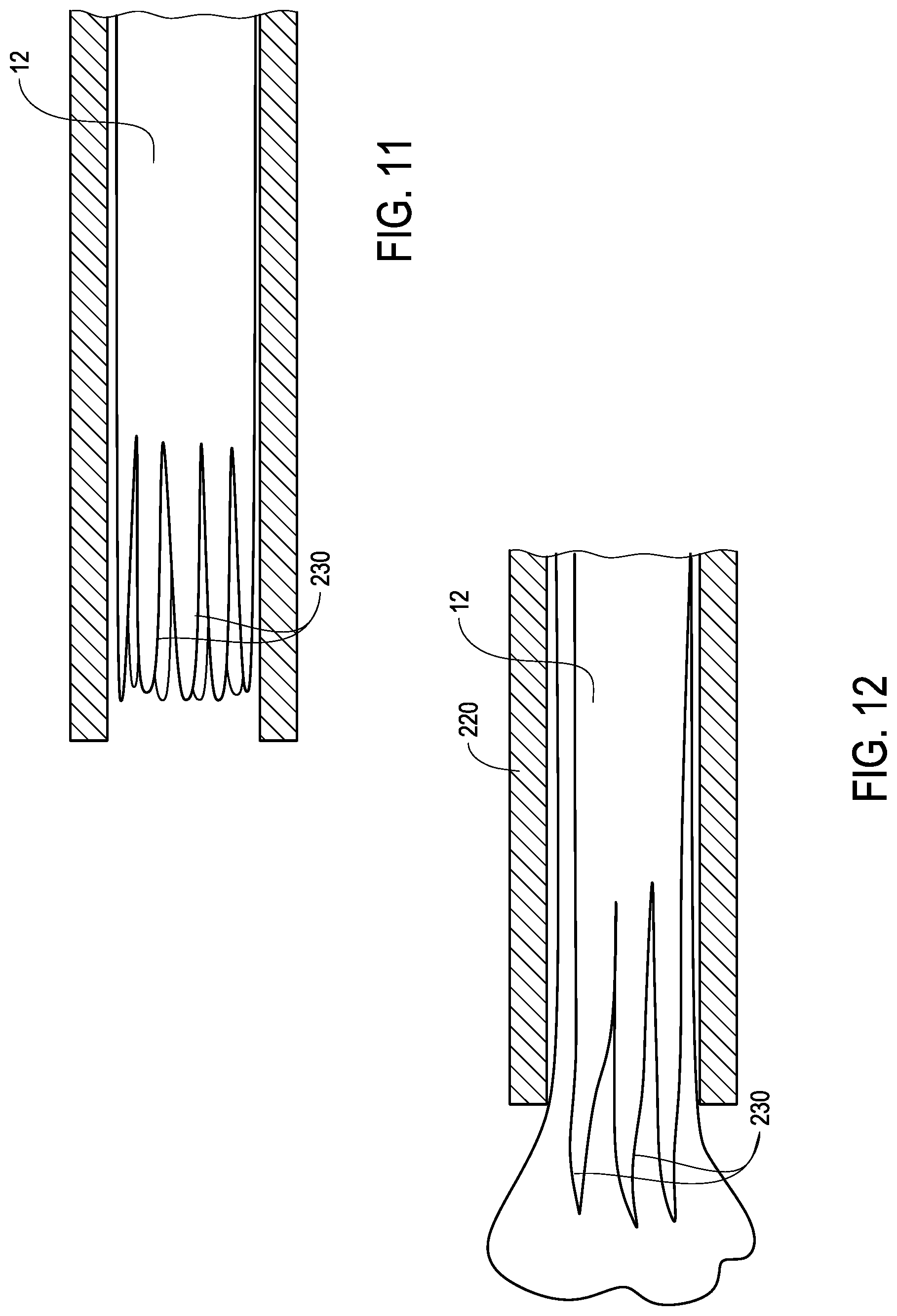 Patent US12324888 Figure 11 – Ureteral stent with anti-migration features