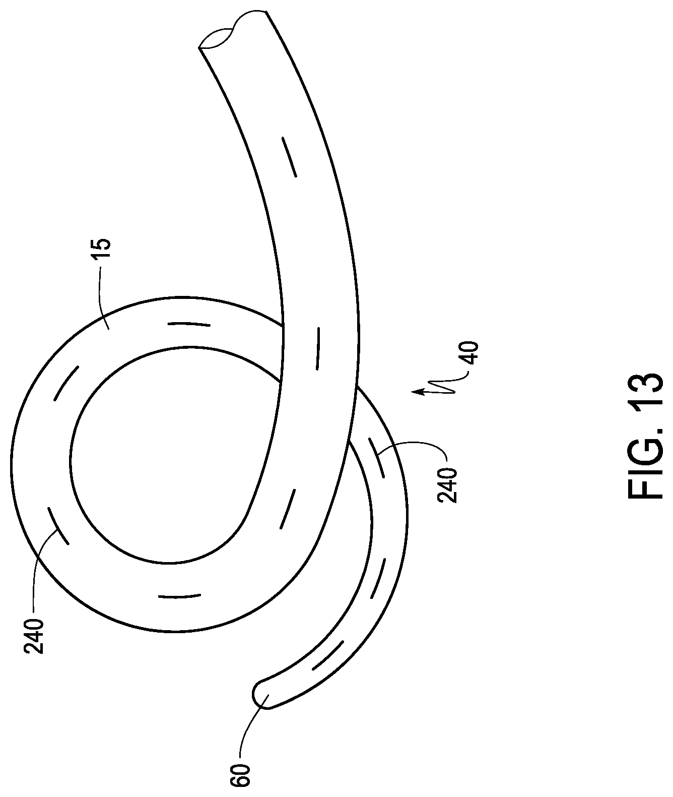 Patent US12324888 Figure 12 – Ureteral stent with anti-migration features