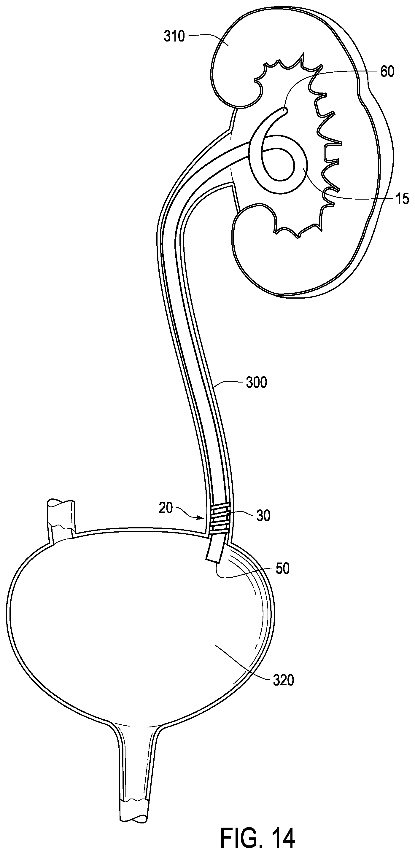 Patent US12324888 Figure 13 – Ureteral stent with anti-migration features