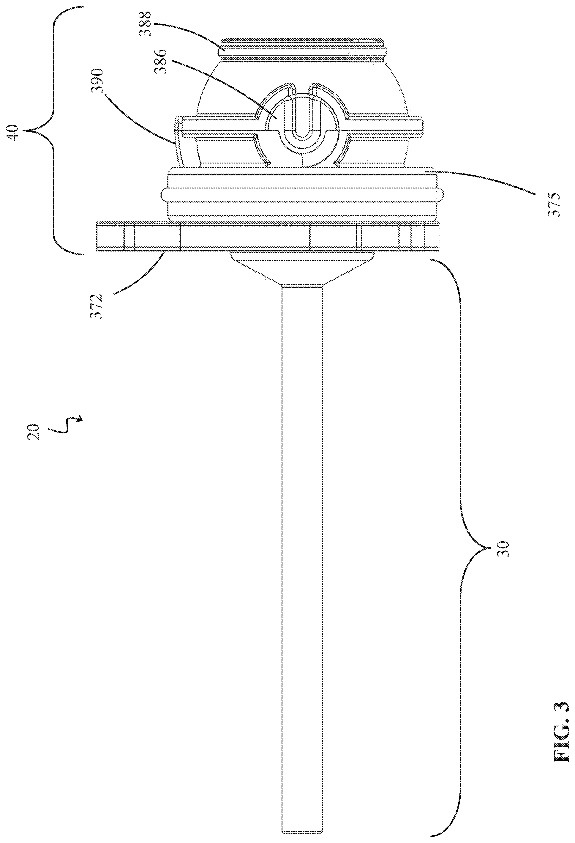 Patent US12324894 Figure 3 – Percutaneous access pathway system