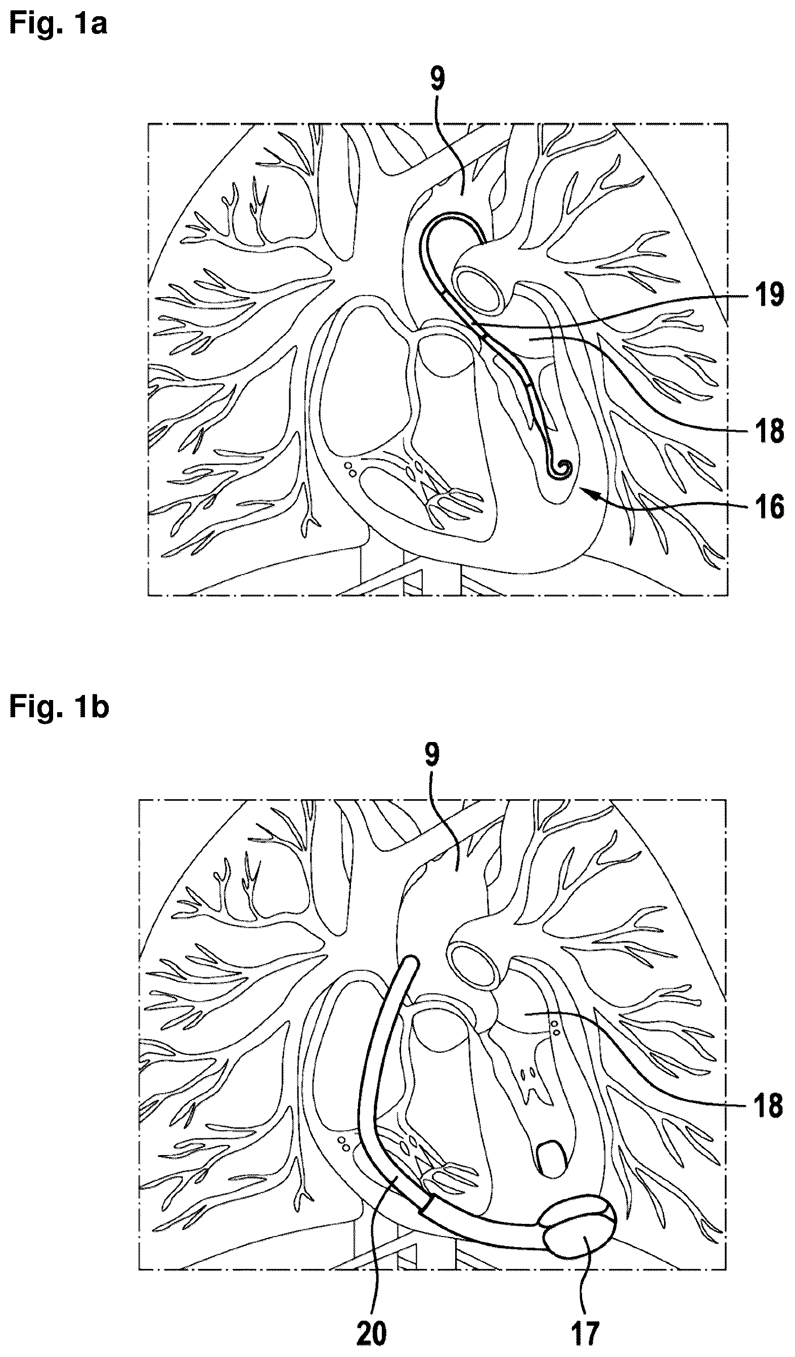 Patent US12324906 Figure 1 – Systems and methods for determining a total blood volume flow in a cardiac support system and vascular support system