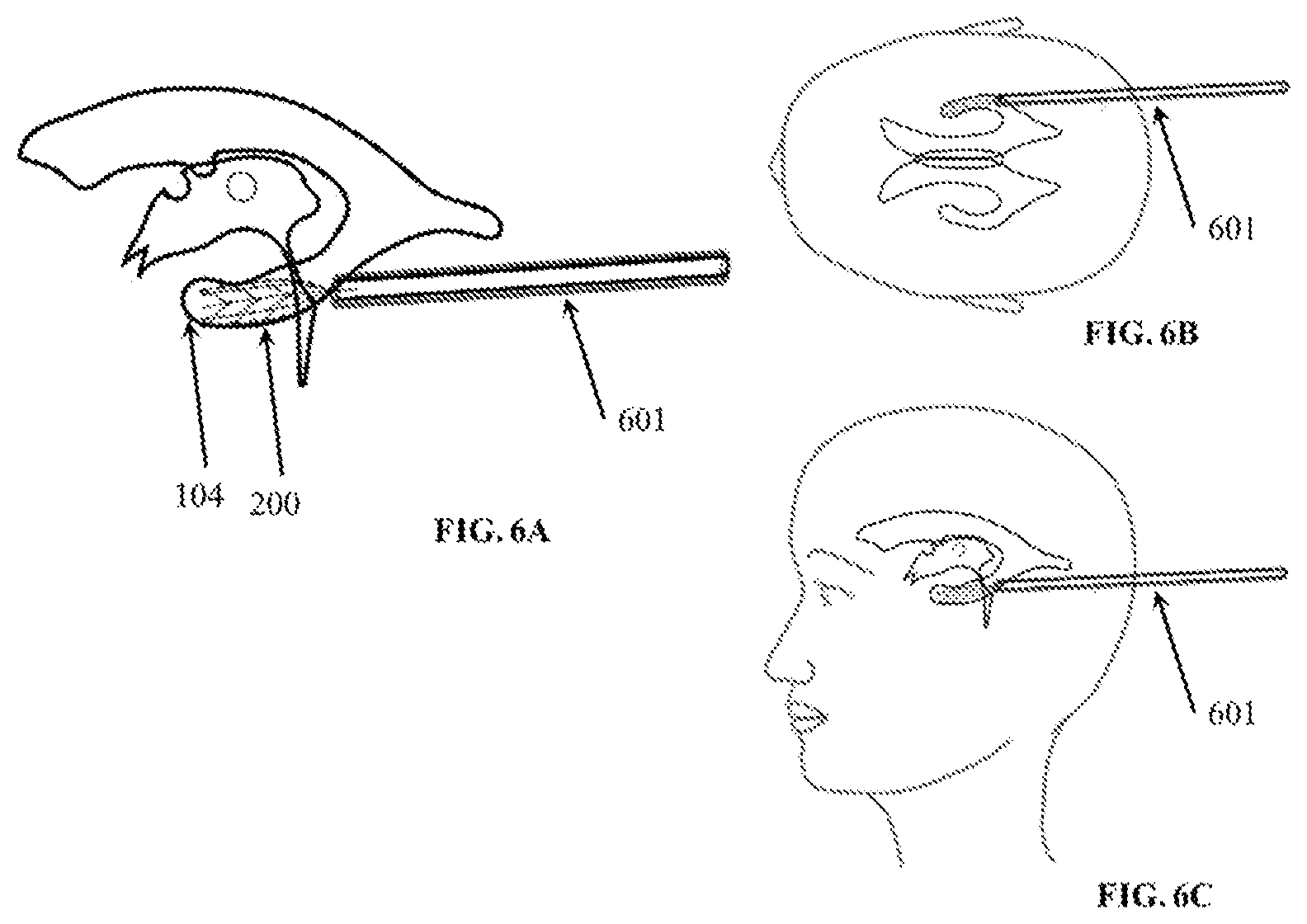 Patent US12324910 Figure 6 – Visual prosthesis employing ventricular or endovascular neural electrode arrays
