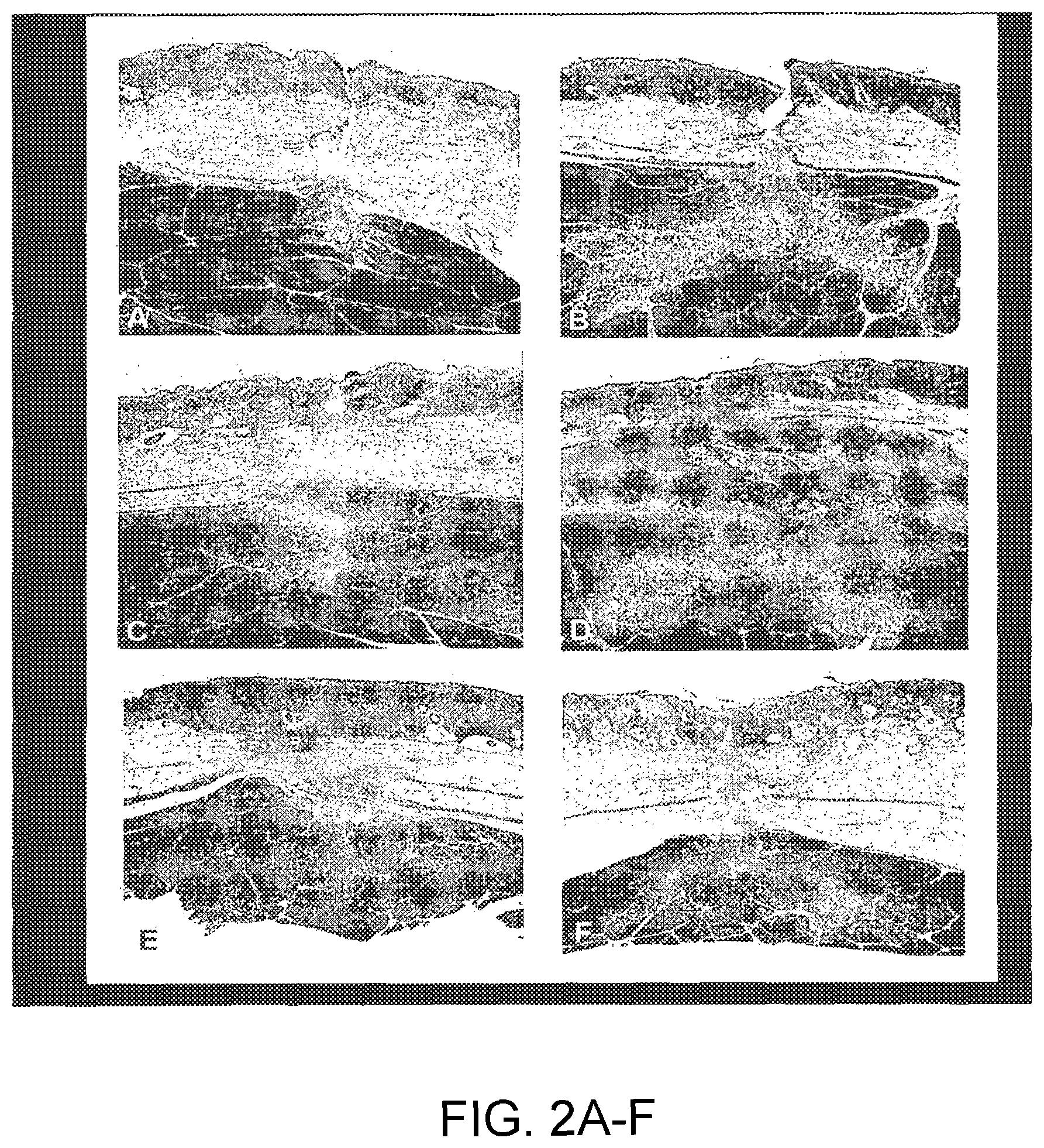 Patent US12324913 Figure 2 – Method and device for treating microscopic residual tumors remaining in tissues following surgical resection