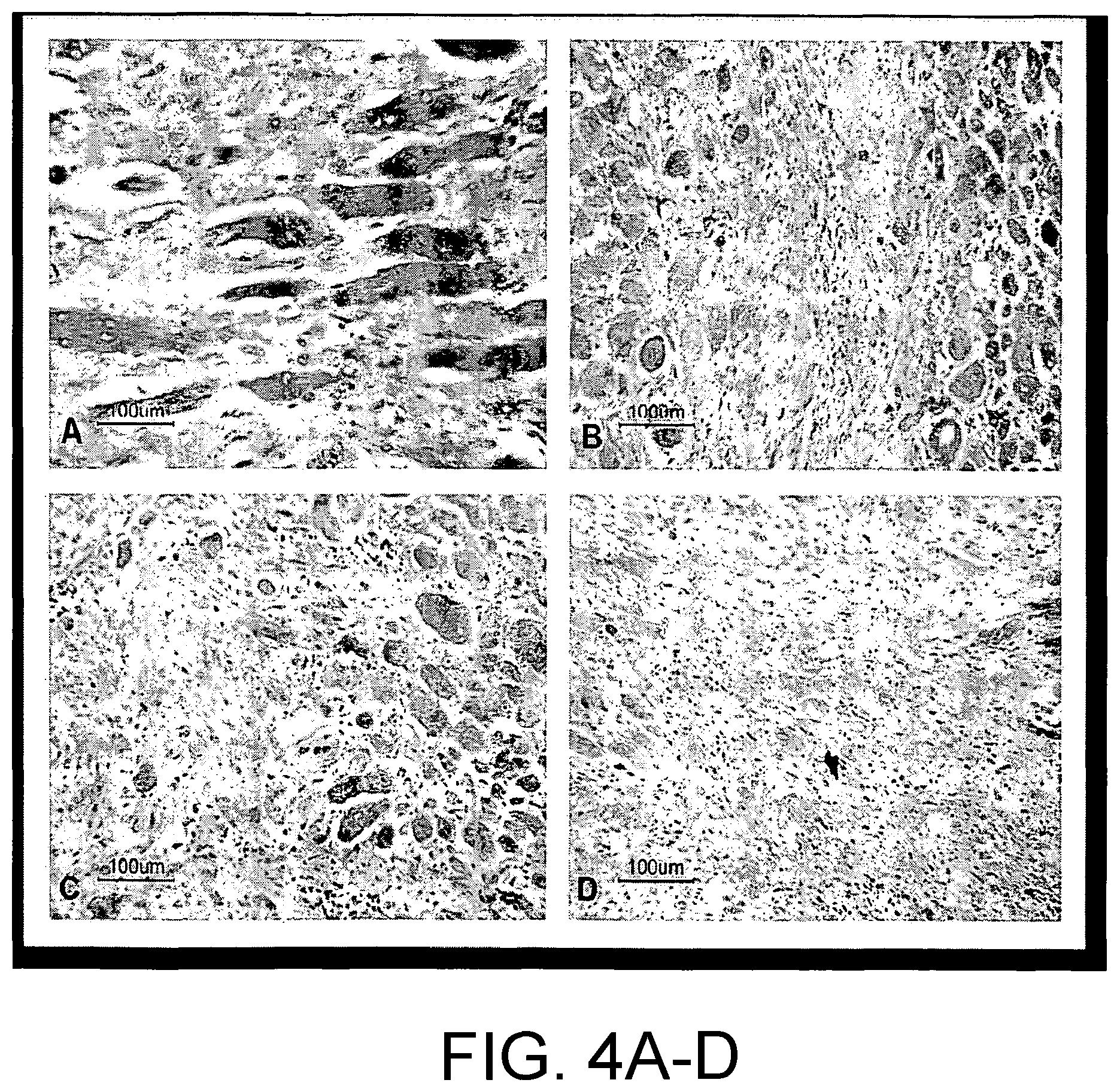 Patent US12324913 Figure 4 – Method and device for treating microscopic residual tumors remaining in tissues following surgical resection