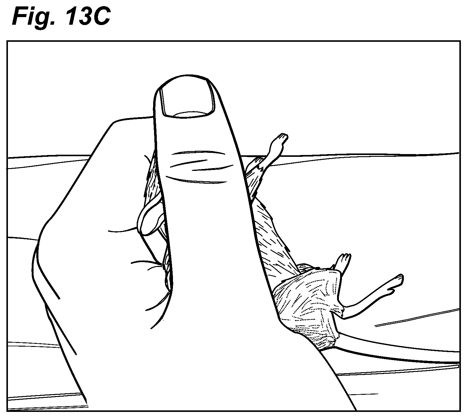 Patent US12324913 Figure 15 – Method and device for treating microscopic residual tumors remaining in tissues following surgical resection