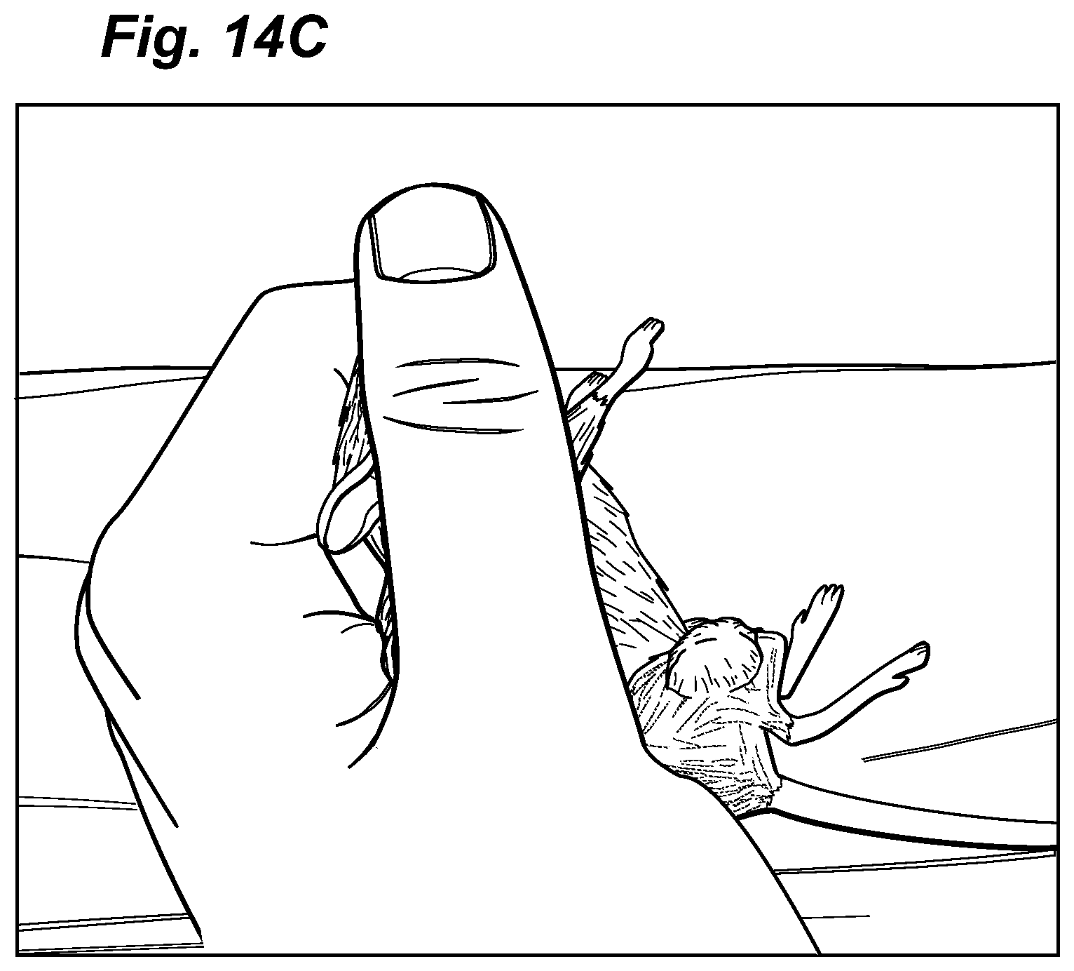 Patent US12324913 Figure 17 – Method and device for treating microscopic residual tumors remaining in tissues following surgical resection