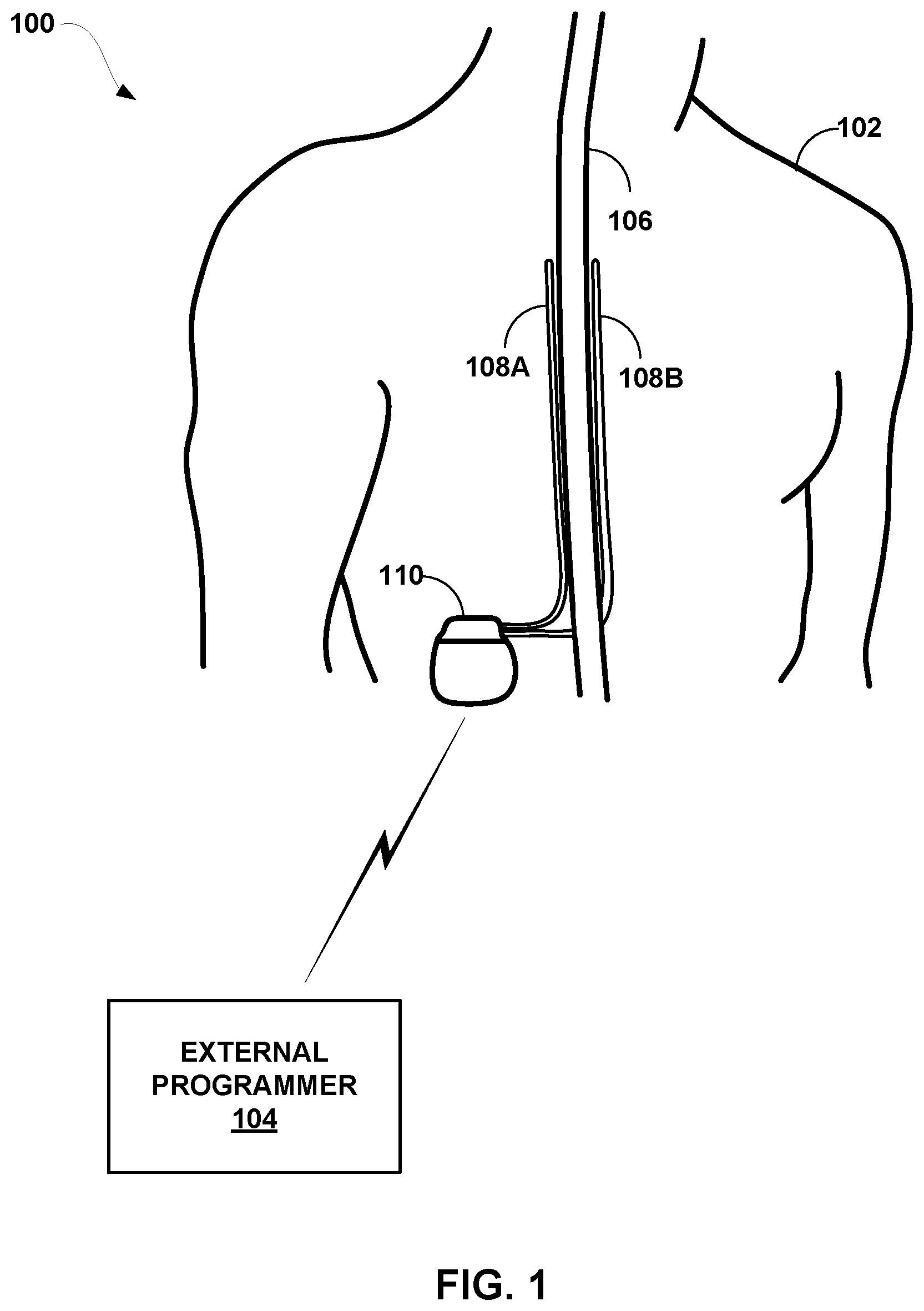 Patent US12324916 — Hybrid control policy for ECAP-servoed neuromodulation — Figure 1