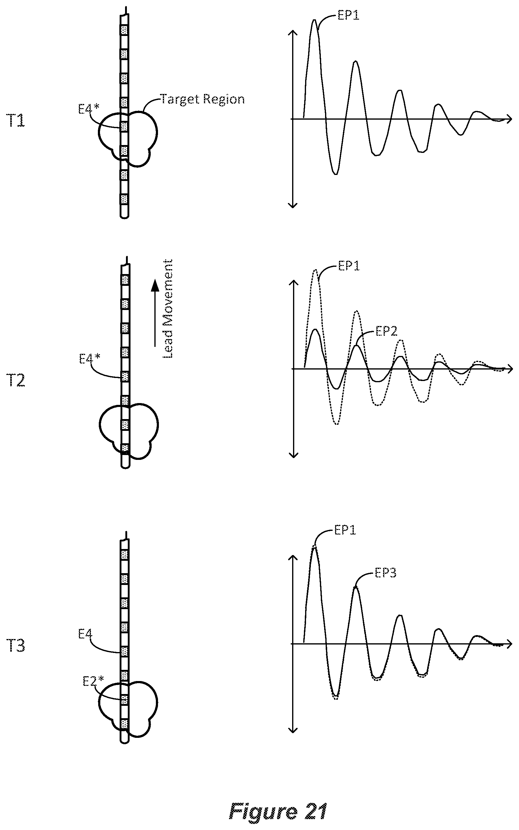 Patent US12324918 Figure 18 – Methods and systems for lead movement detection and response in DBS therapy