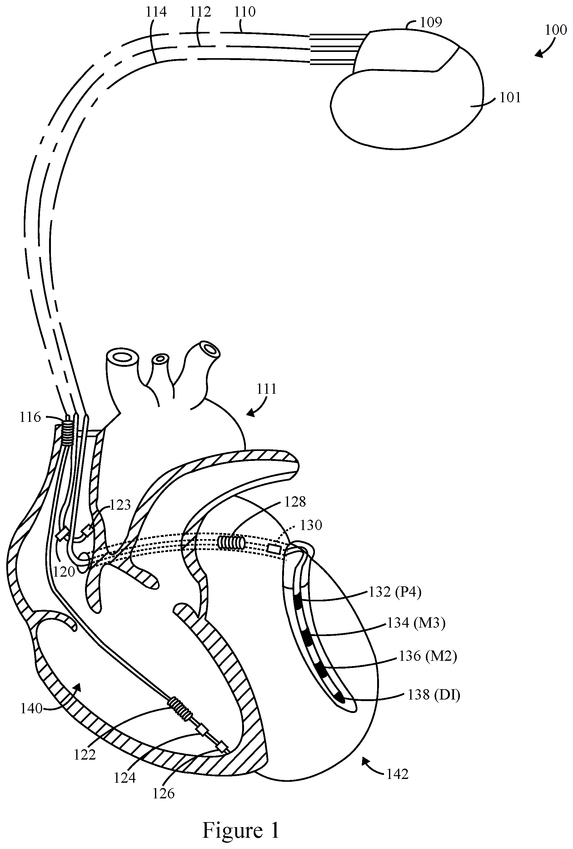 Patent US12324919 — Method and system for biventricular or left ventricular pacing — Figure 1