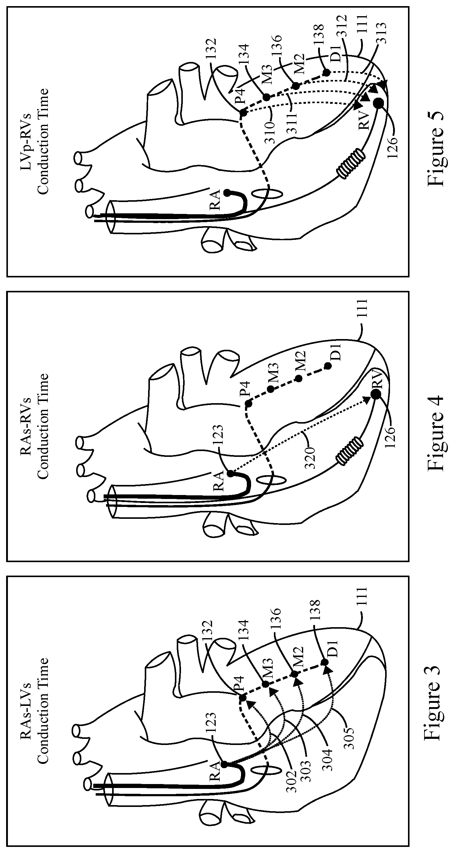 Patent US12324919 Figure 3 – Method and system for biventricular or left ventricular pacing