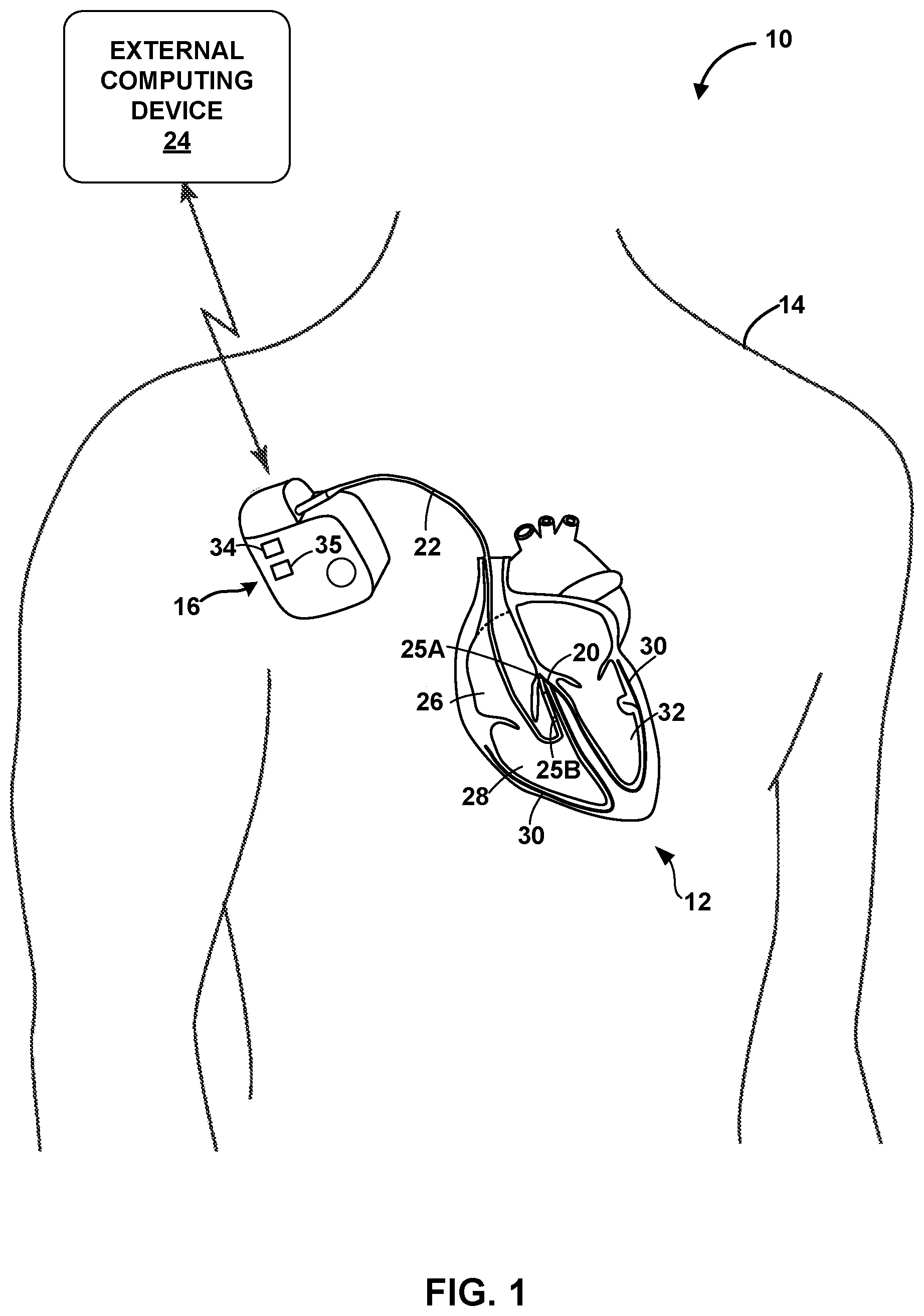 Patent US12324920 Figure 1 – Implantable medical device with pacing capture classification