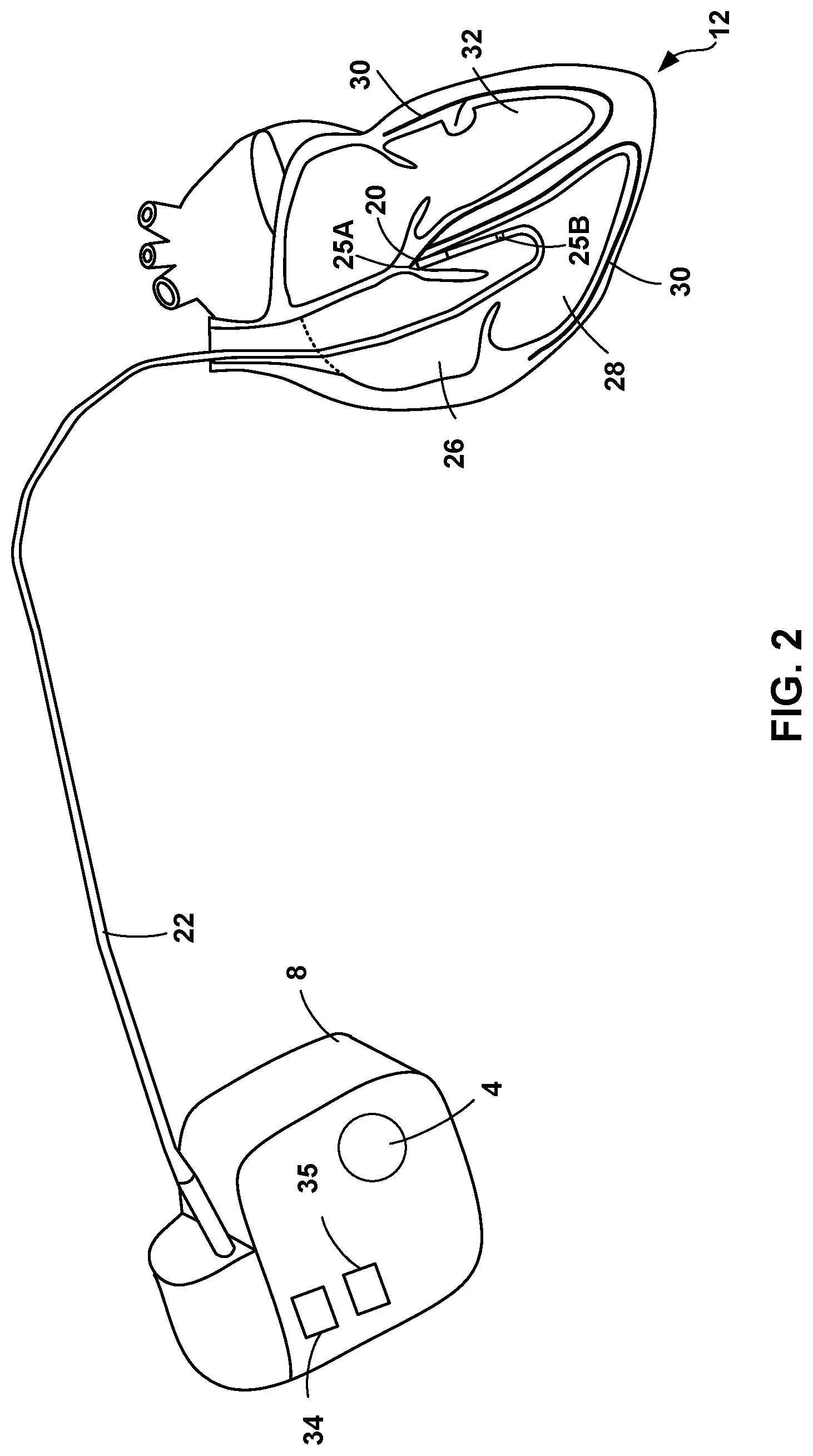 Patent US12324920 Figure 2 – Implantable medical device with pacing capture classification