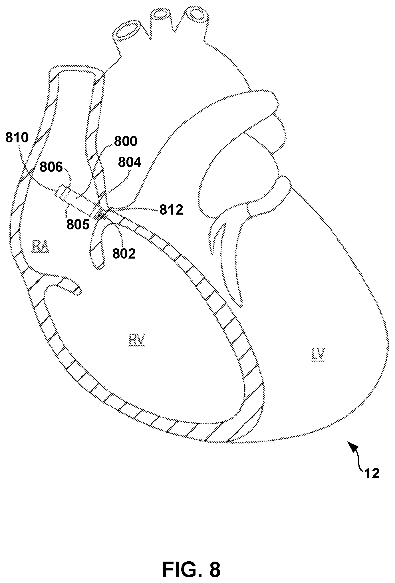 Patent US12324920 Figure 8 – Implantable medical device with pacing capture classification
