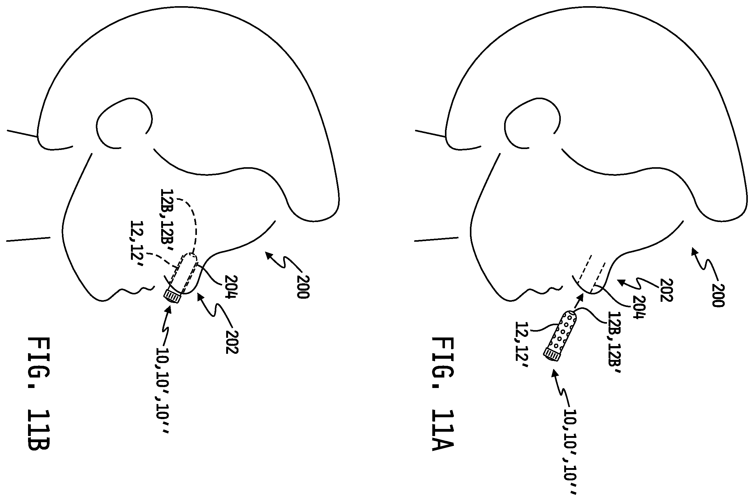 Patent US12324926 Figure 6 – Device and method for eradicating pathogens in nasal passages