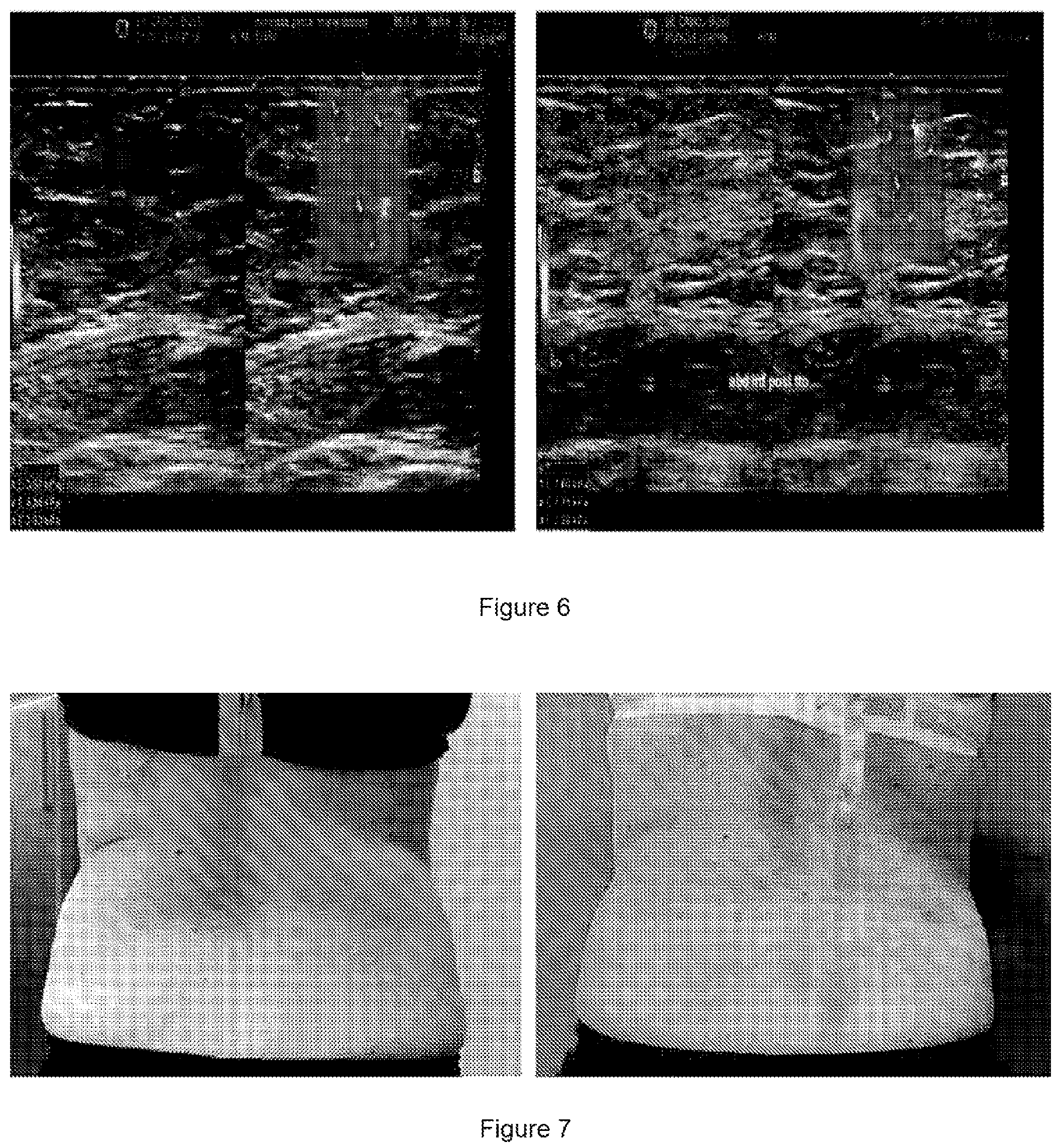 Patent US12324935 Figure 6 – Ultrasound-emitting apparatus for applying selective treatments to adipose tissue in body rejuvenation/remodelling processes
