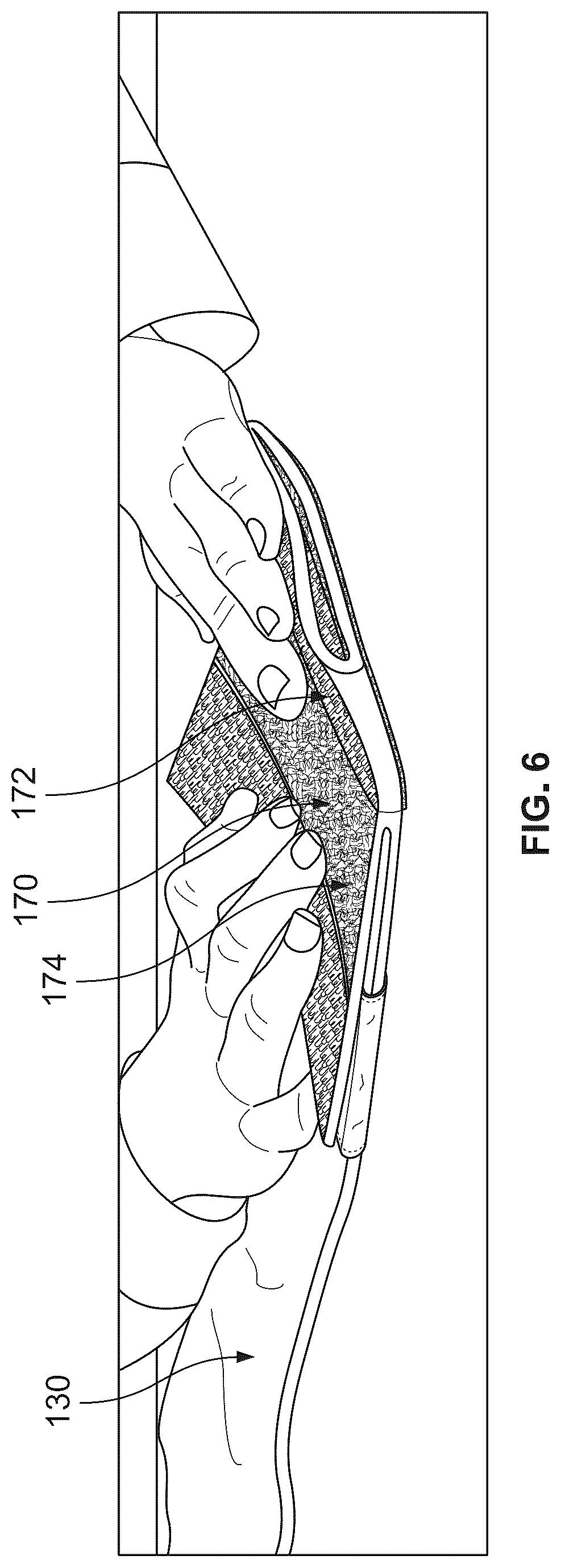 Patent US12324942 Figure 6 – Exercise bag system with multi-locking closure system
