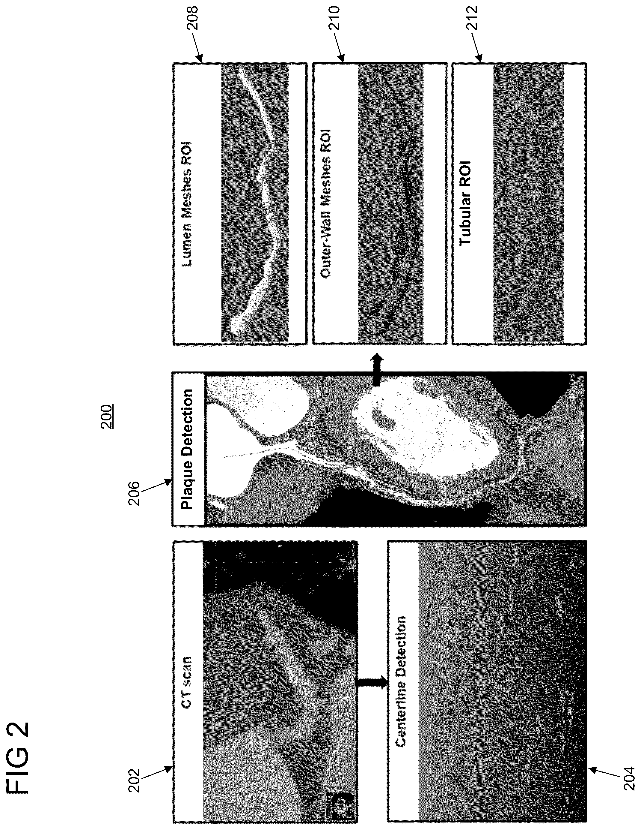Patent US12327349 Figure 2 – Fully automated assessment of coronary vulnerable plaque in coronary CT images using radiomic features