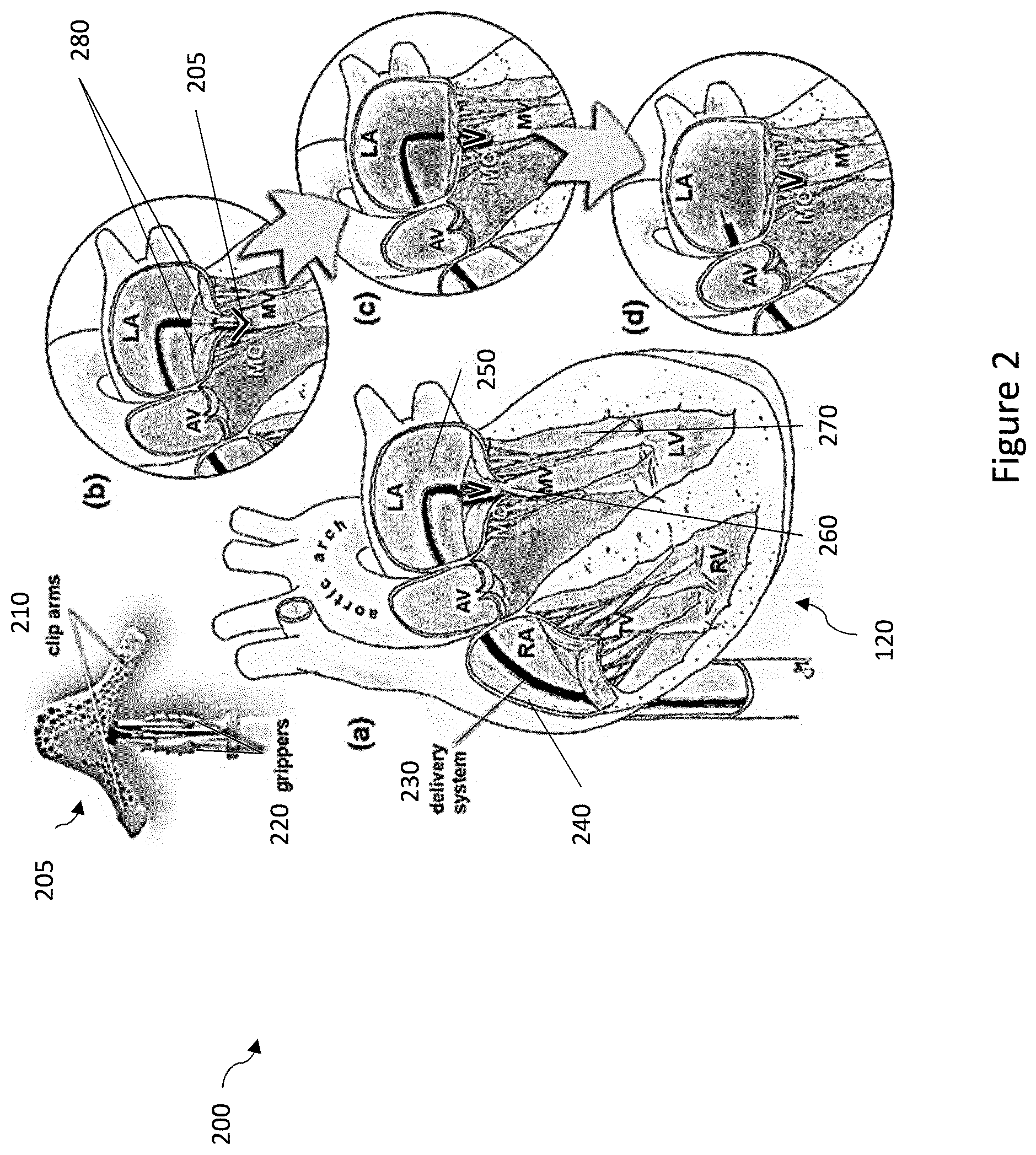 Patent US12327351 Figure 2 – Medical imaging systems, devices, and methods for visualizing a deployment state of an intracorporeal therapeutic device